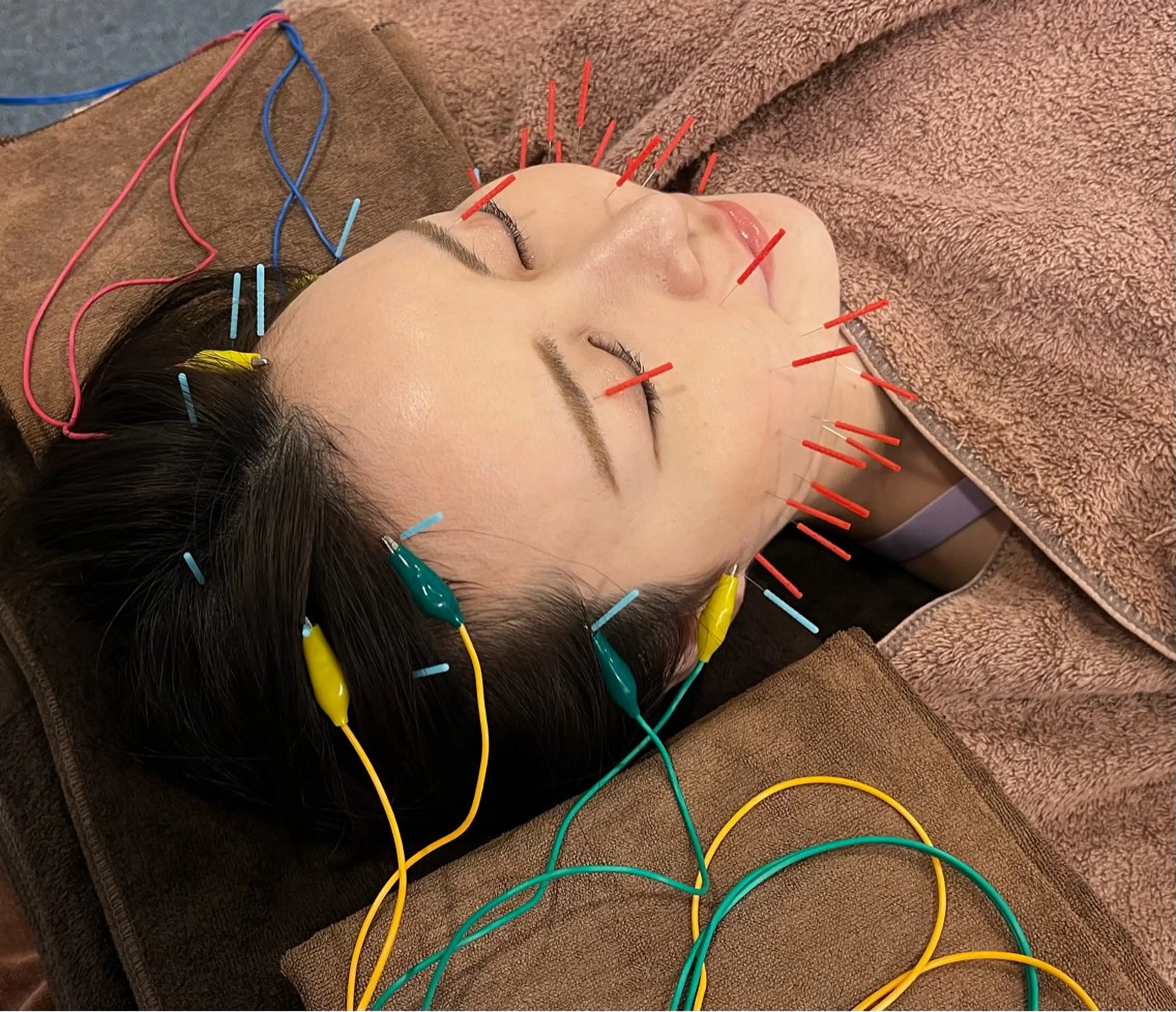 ミニモ学割　【整顔美容鍼】鍼+電気パルスのみ 60分の写真