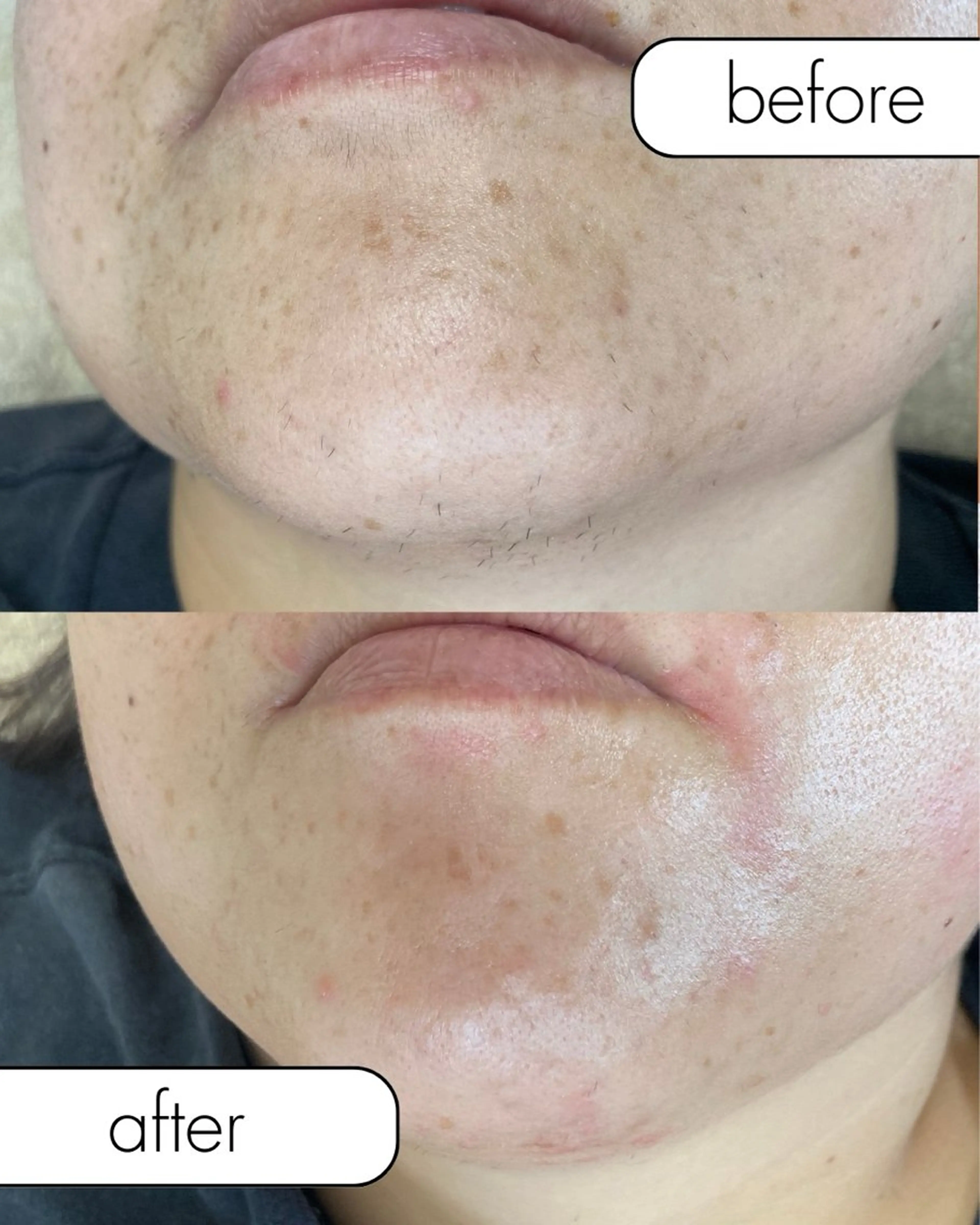 脱毛 蝶式糸除毛専門salon aco所属・糸除毛専門salon acoのエステ・リラクイメージ