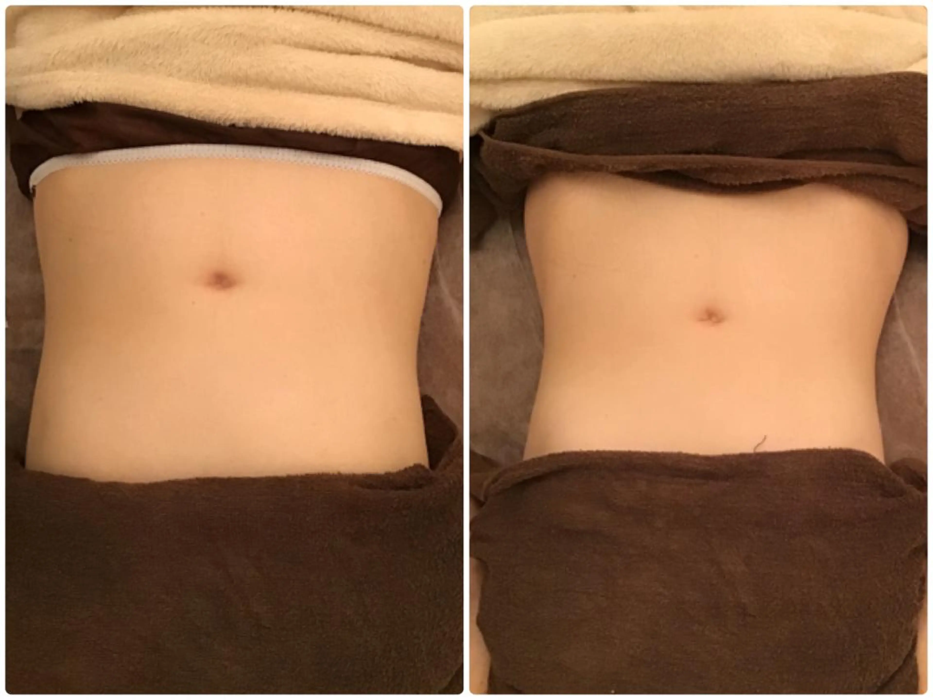 ○痛くないセル脂肪ケア　（お腹）の写真