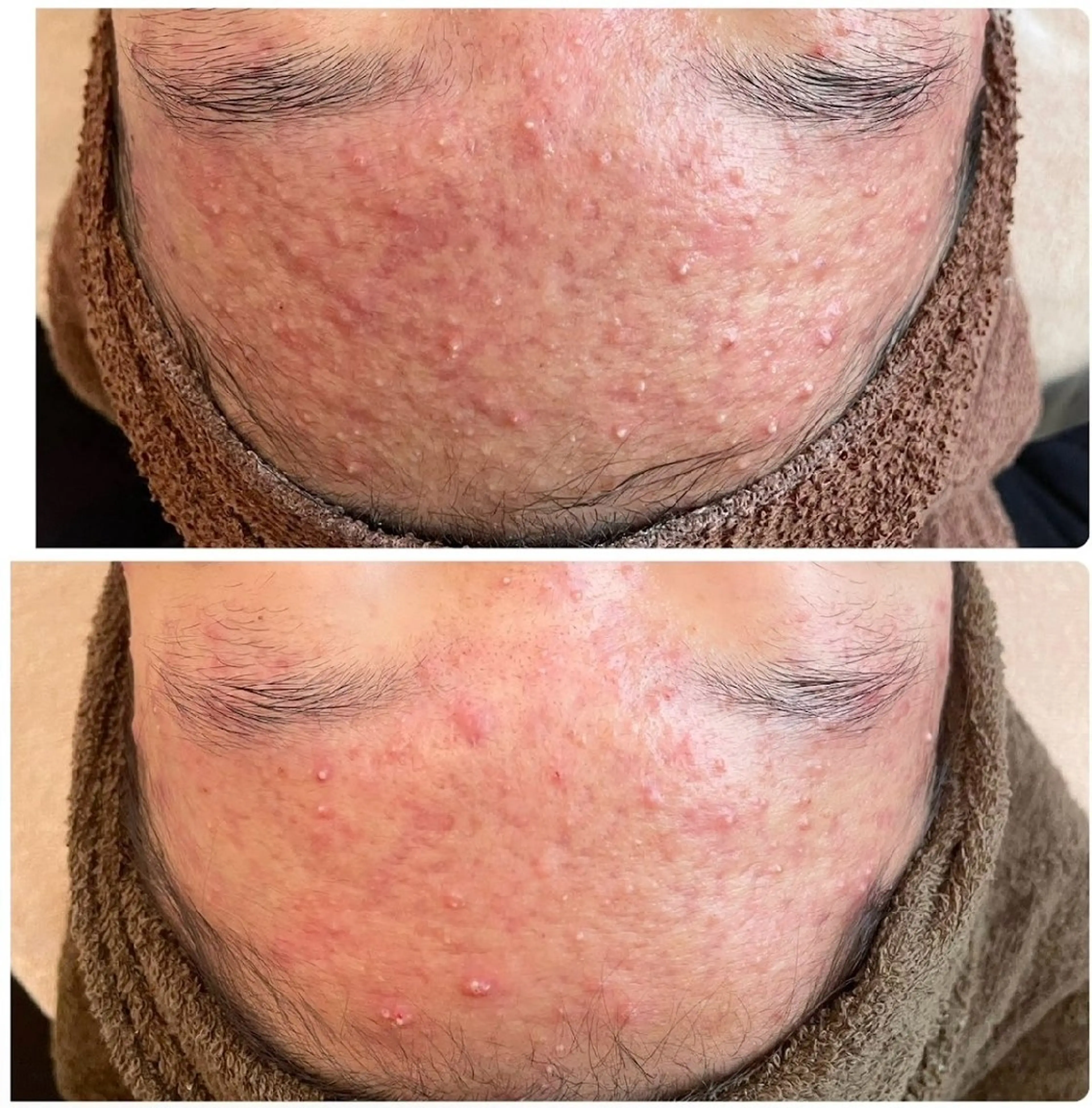 【本気のニキビケア】ハーブピーリング×幹細胞ポレーション入込み×水分パック ニキビ/ニキビ跡/肌荒れ/潤い/毛穴ケアの写真