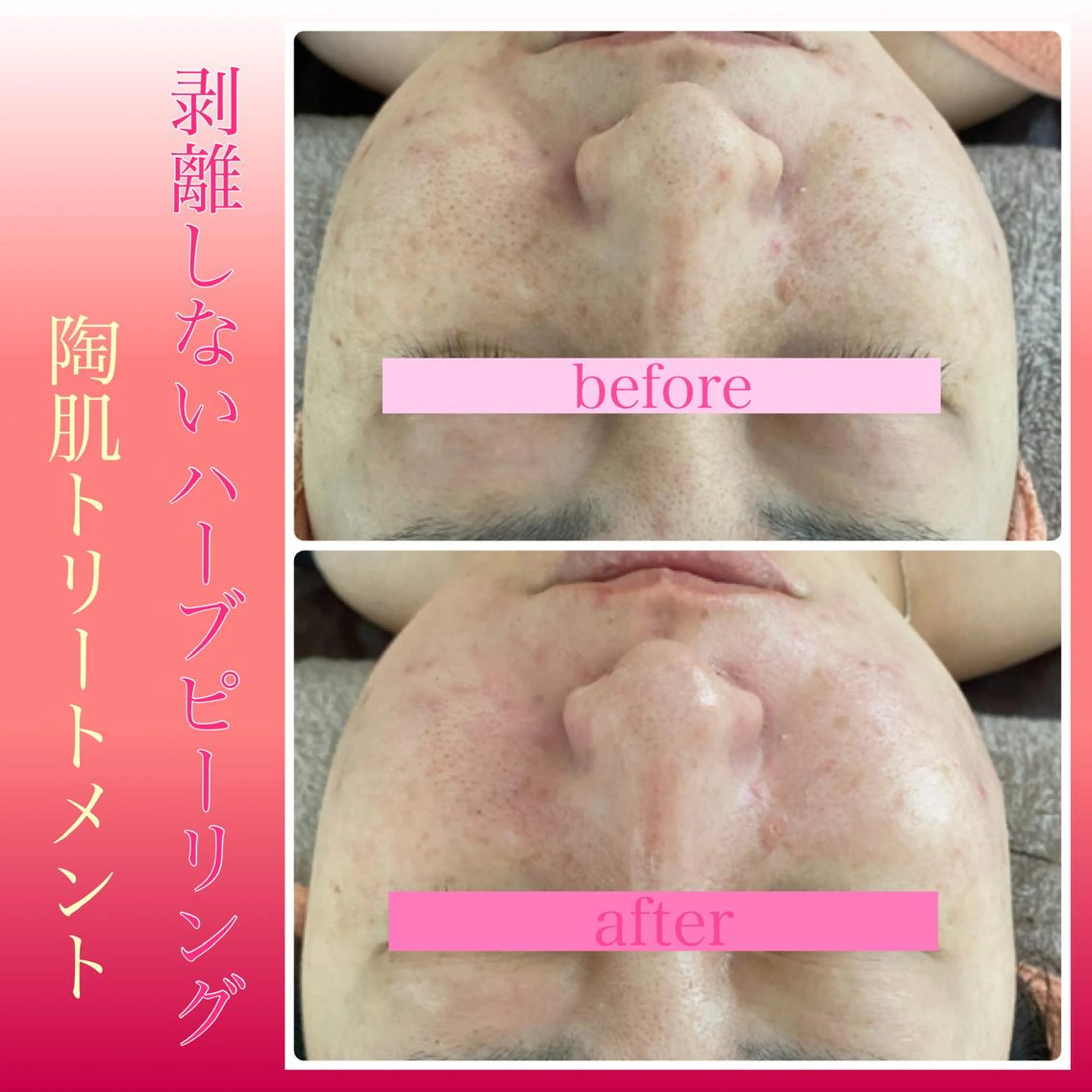 Chalon所属・REVI取扱・肌悩み 毛穴Chalonのエステ・リラクイメージ