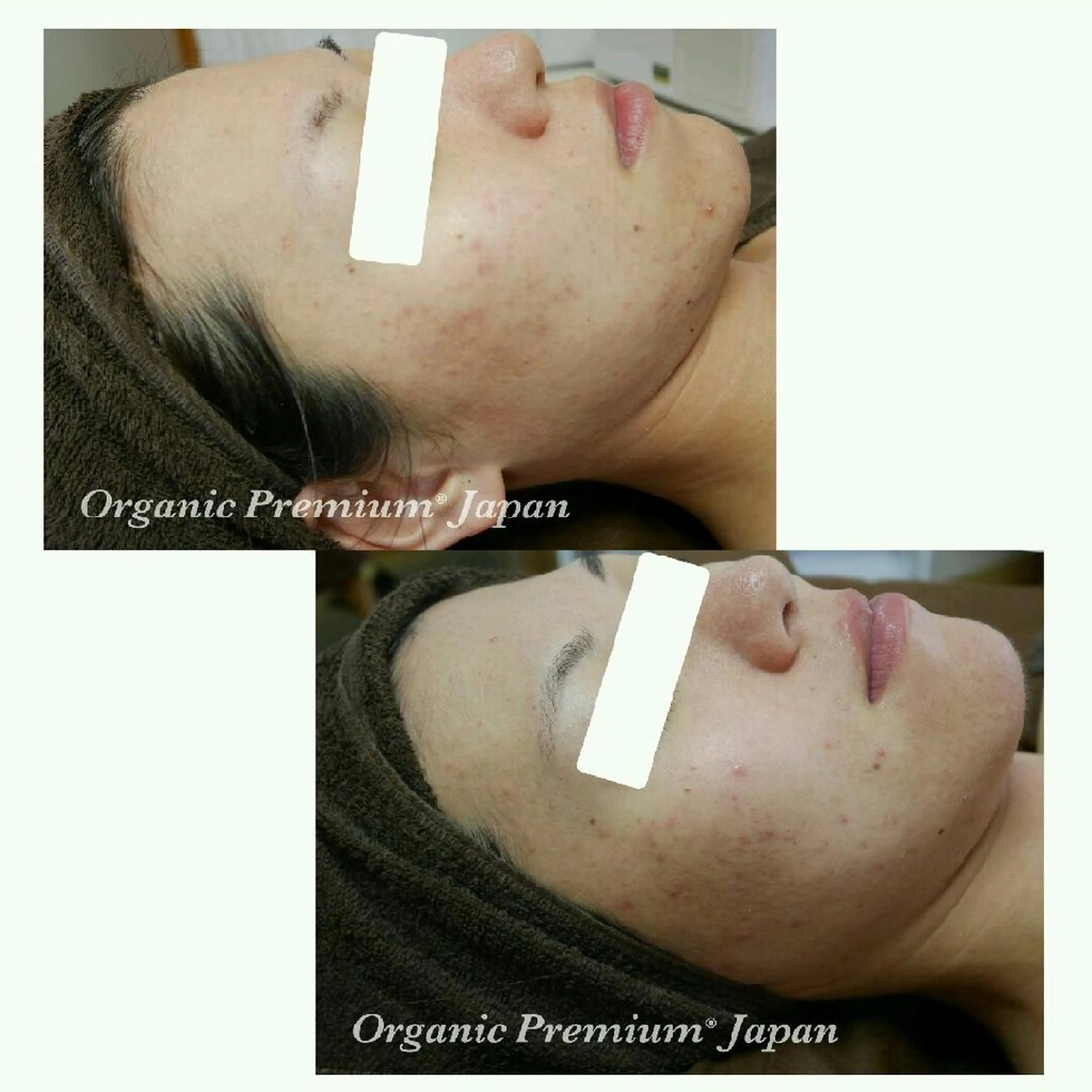 自己再生治癒力を高める！ニキビ毛穴開き肌荒れシワ ニードルパウダーorハーブピーリングコース　70分の写真