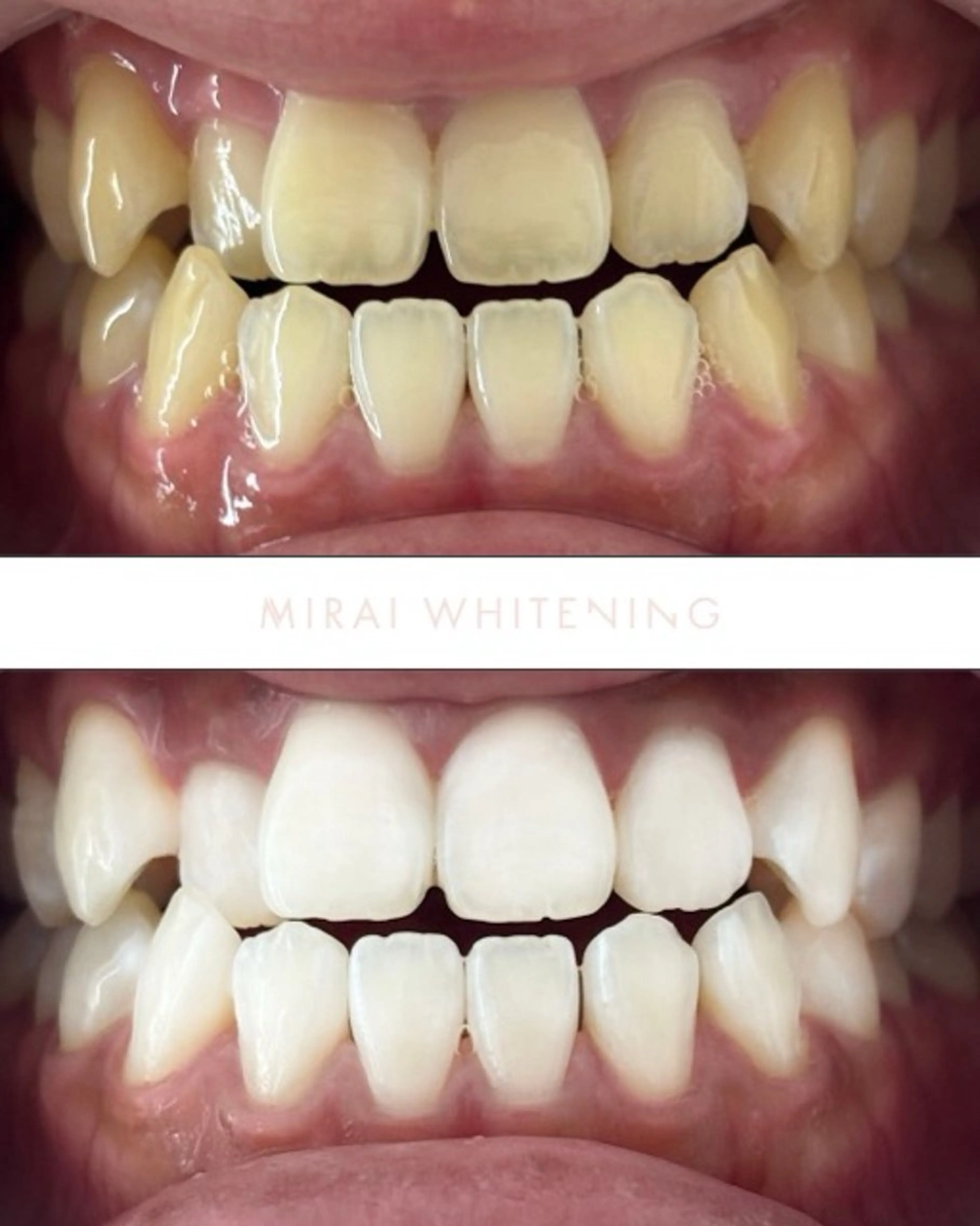 【人気No.1】セルフホワイトニングの写真