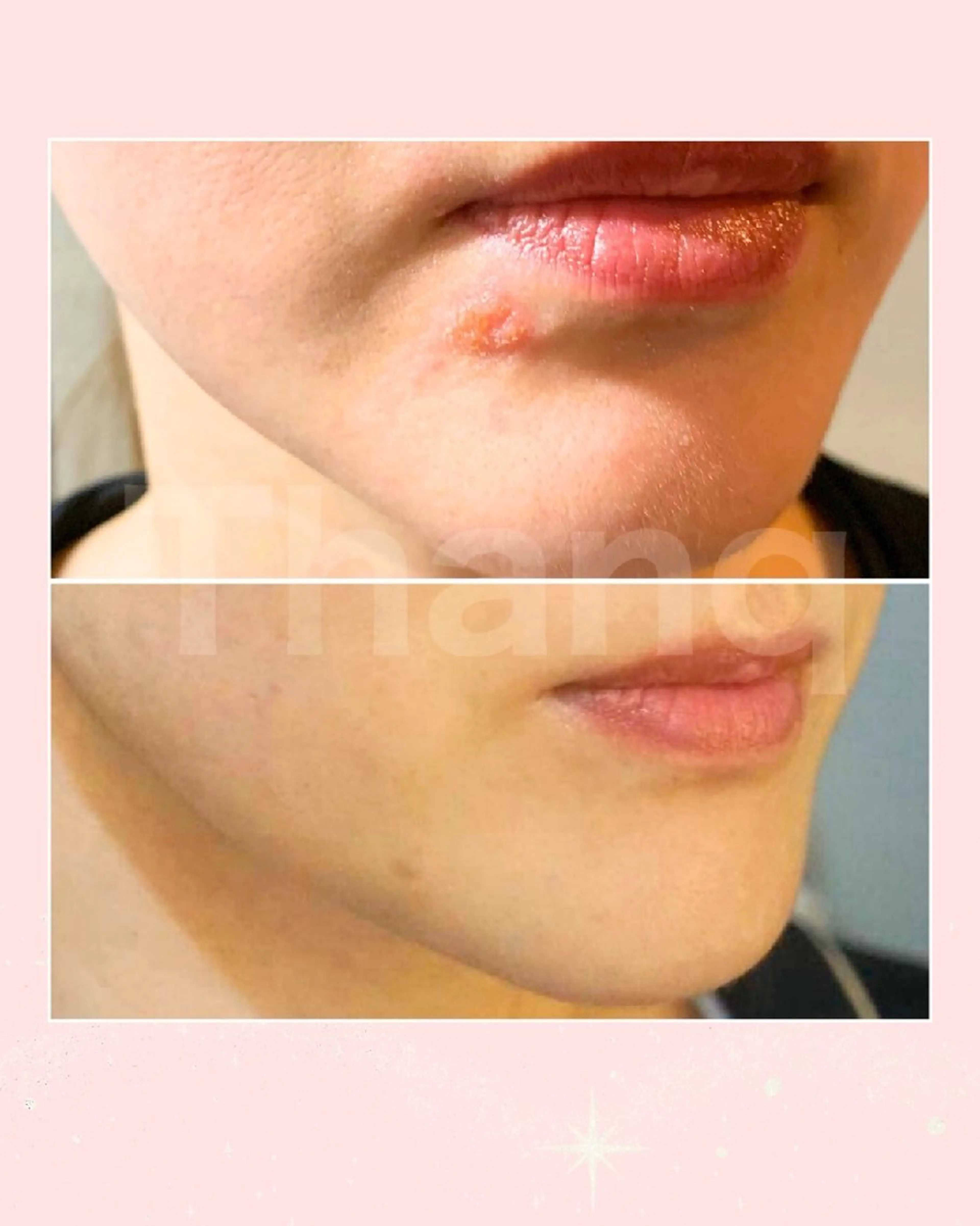 【お悩み：ニキビ】繰り返すニキビ・ニキビ跡ケア　60分（初回カウンセリング・着替え込み120分）の写真