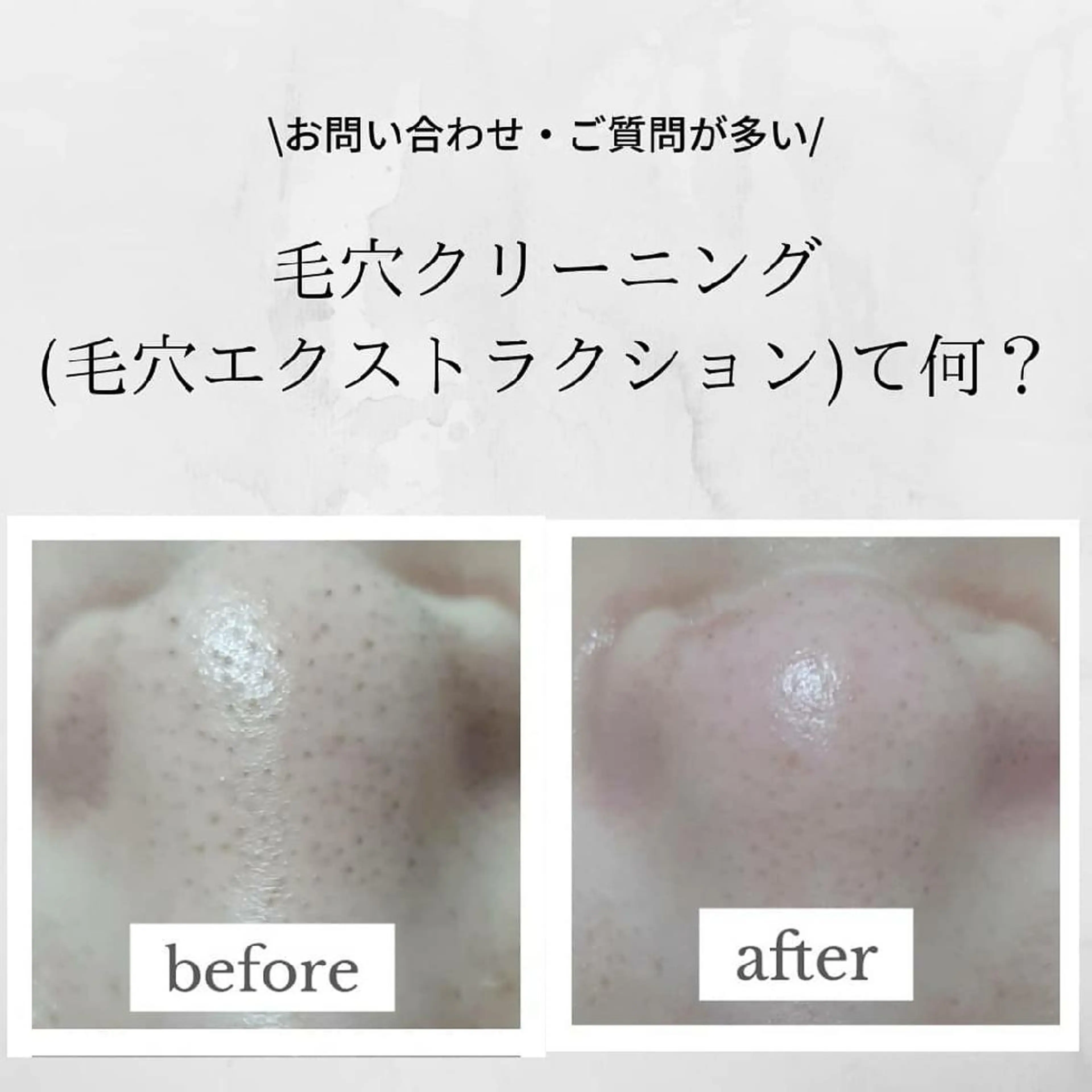 学生様限定✨黒ずみ・詰まり毛穴クリーニングエステの写真