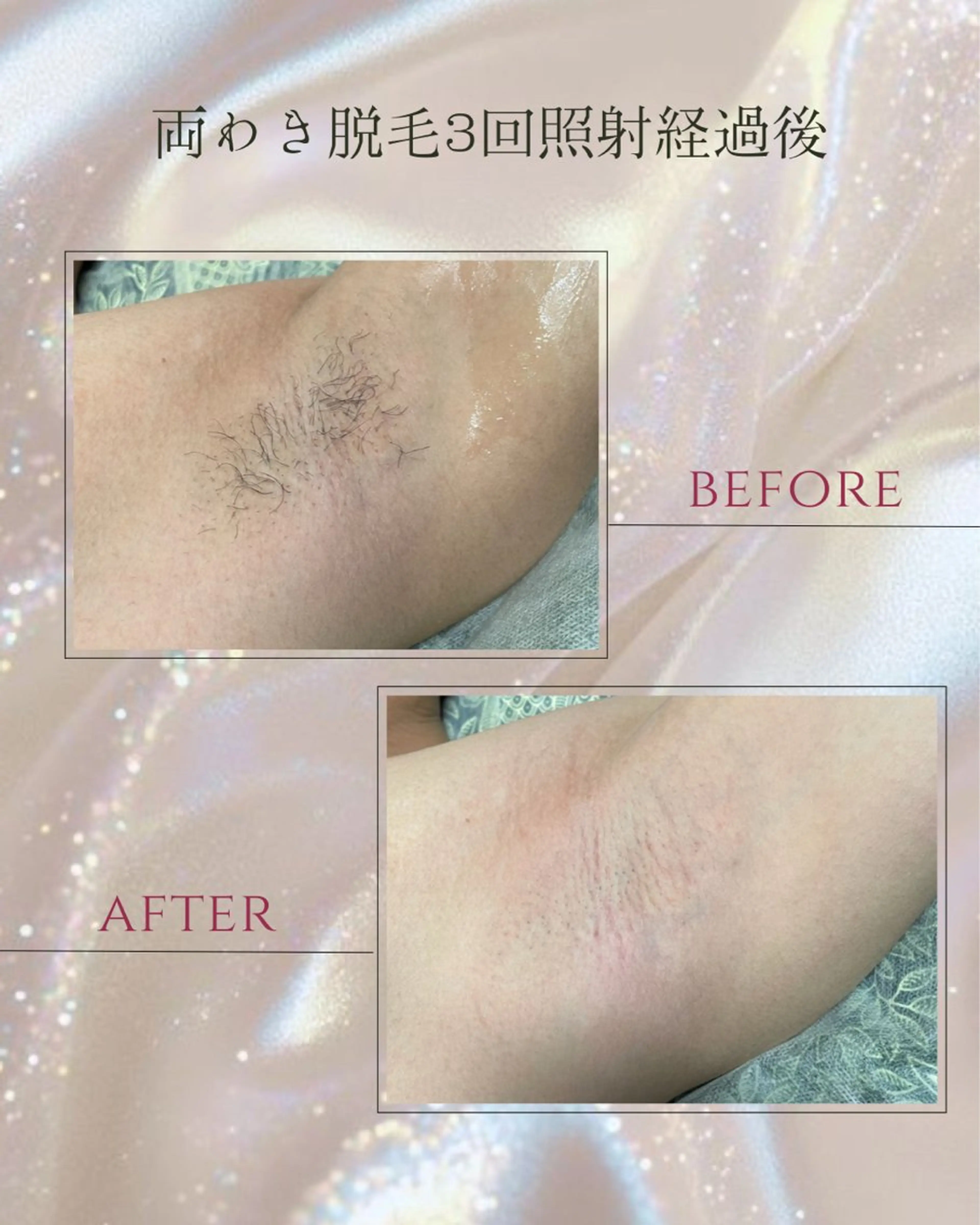 脱毛 DISINI  SPA所属・DISINISPA 脱毛/フェイシャルのエステ・リラクイメージ