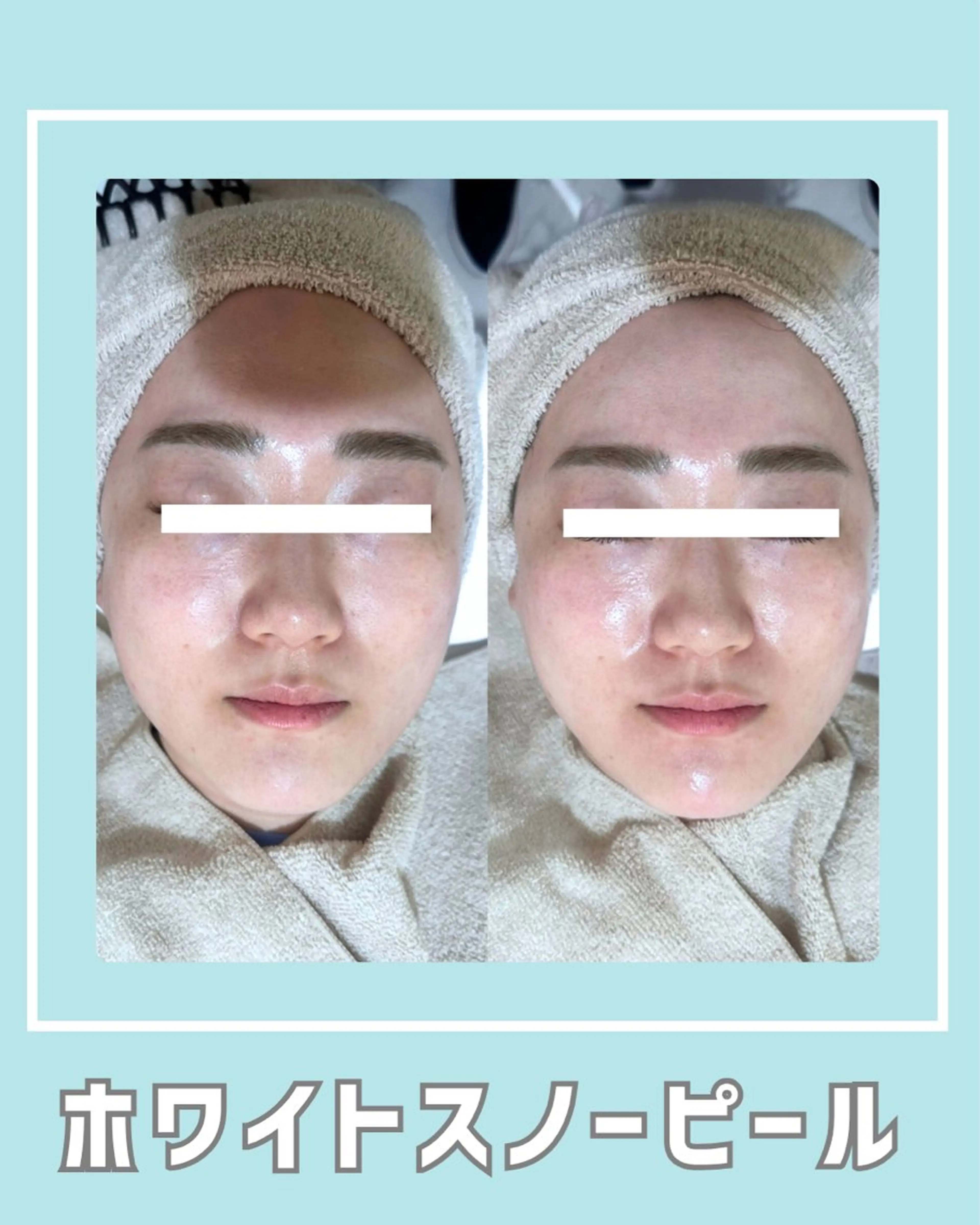 エステ |ピーリング・毛穴| soina神楽坂のエステ・リラクイメージ