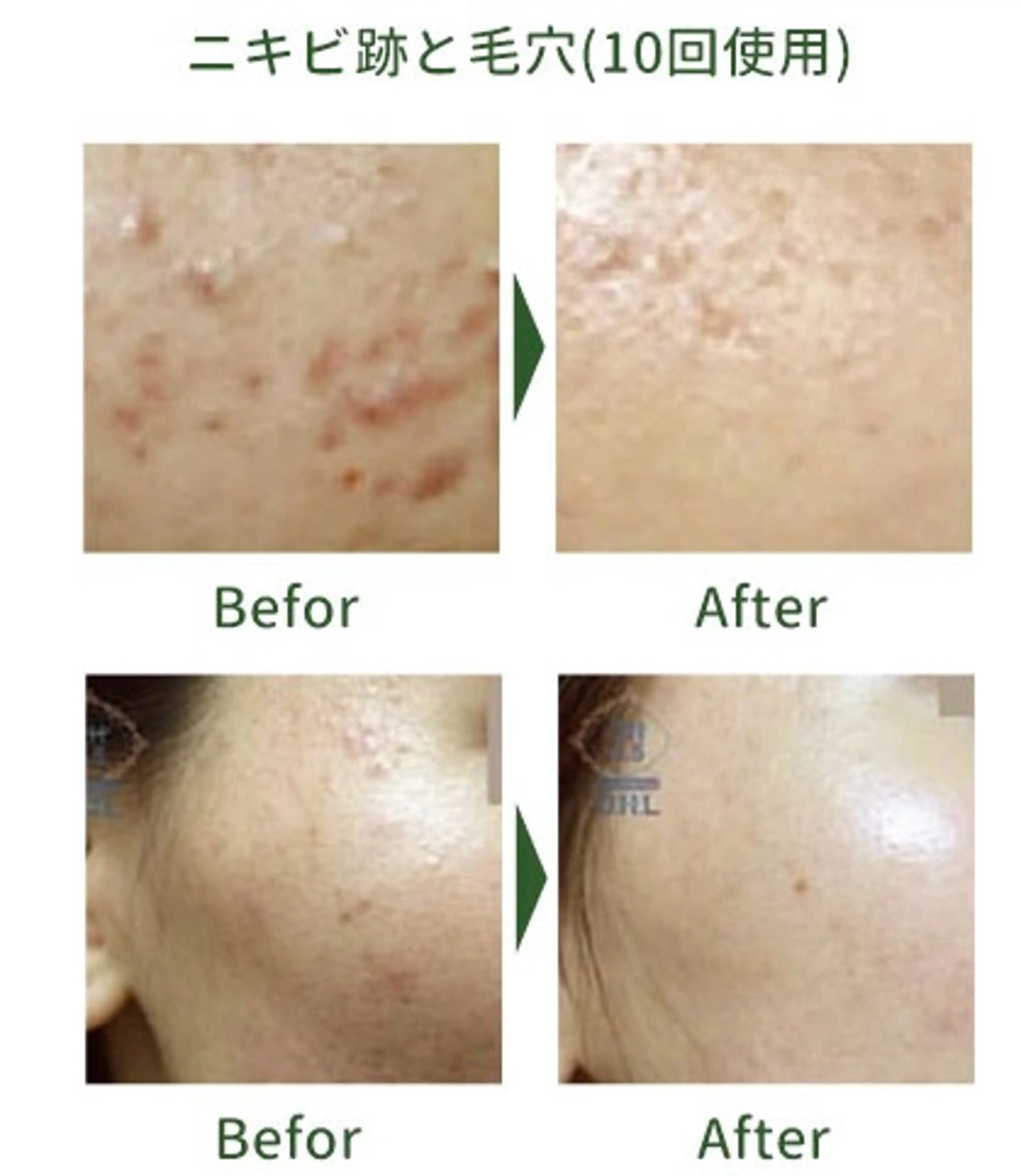 【肌改善】剥離なしハーブピーリング+極潤美白パック+美肌LED【ニキビ・ニキビ跡・肌トラブル改善・美白・乾燥・くすみ】の写真