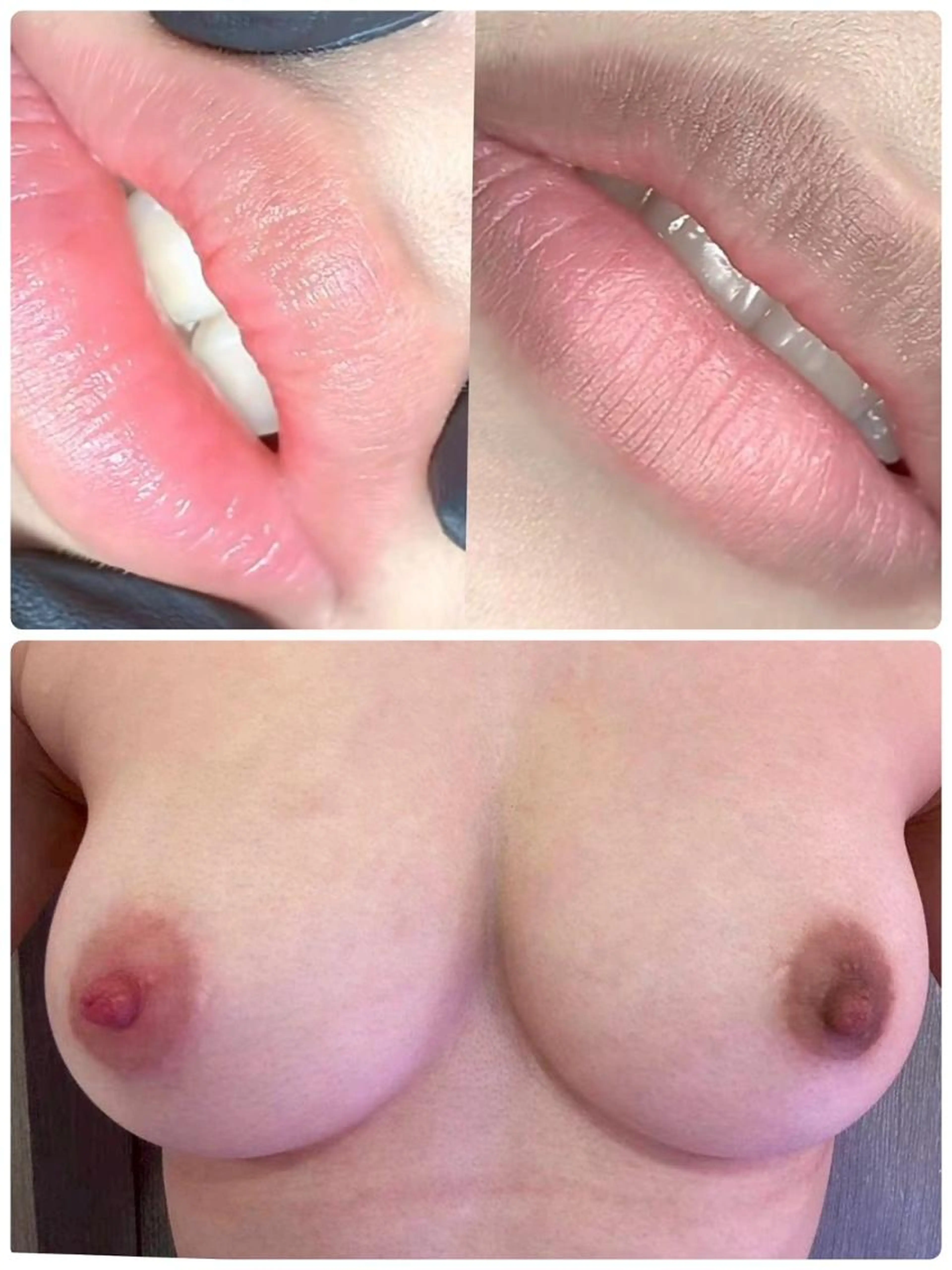 【迷ったらコレ】全身脱毛(顔またはVIO)＋ハイドラ毛穴洗浄　￥16300の写真