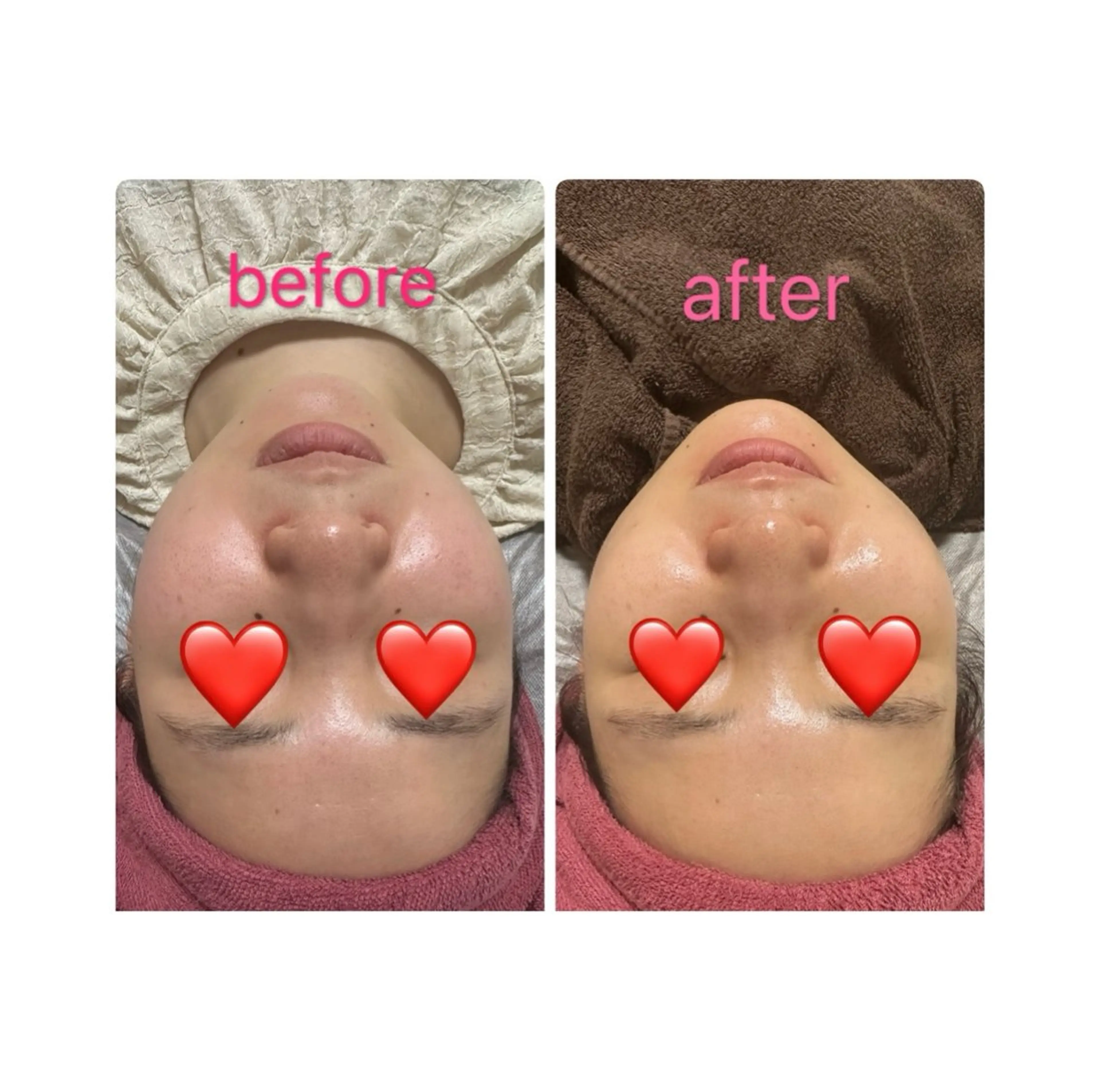 ①⭐️モニター価格⭐️2900円　フェイシャル小顔💎最新リフトアップ機器💎4000shot⭐️お顔と顎下超お得の写真