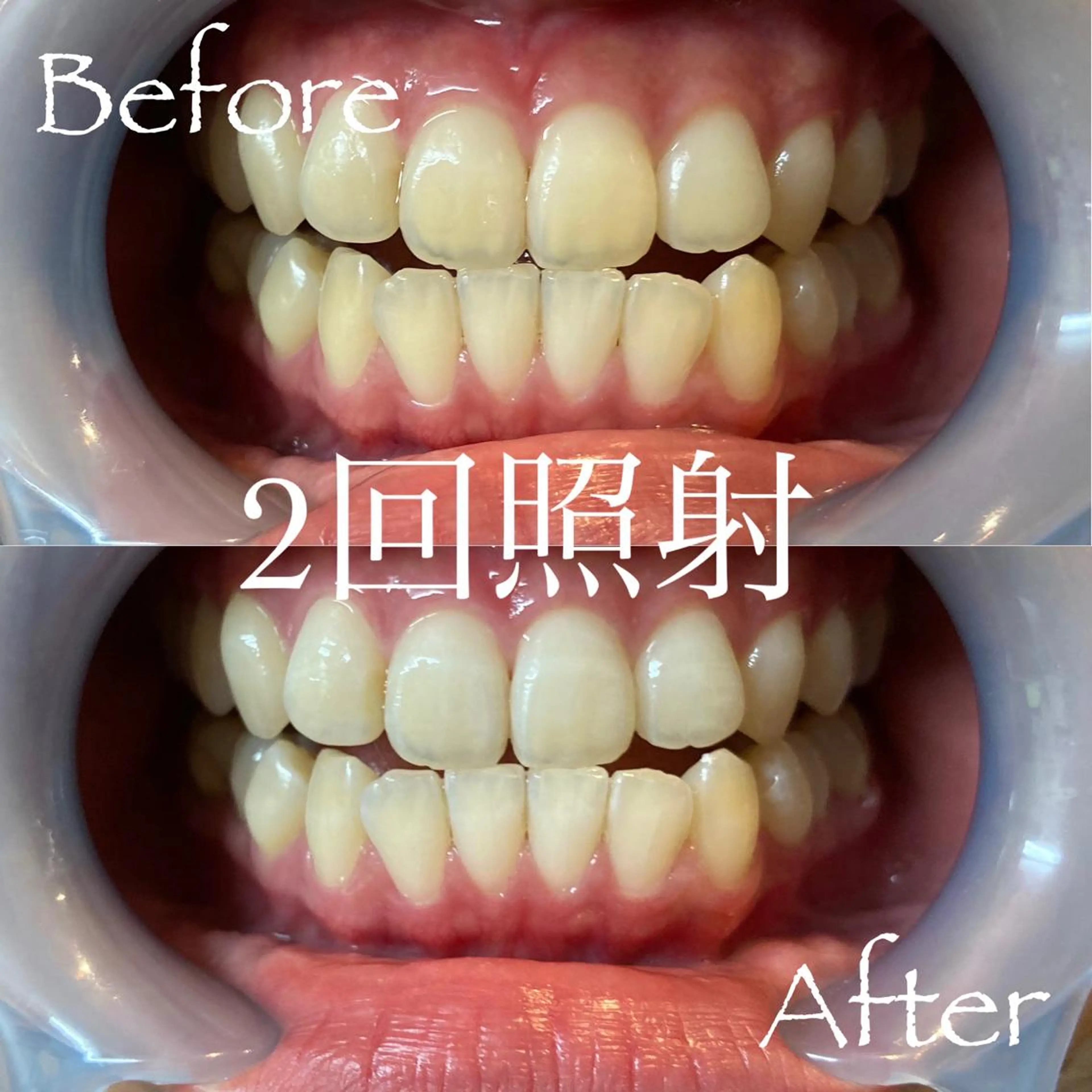 その他 LBSホワイトニング 新宿店💝公式のその他イメージ