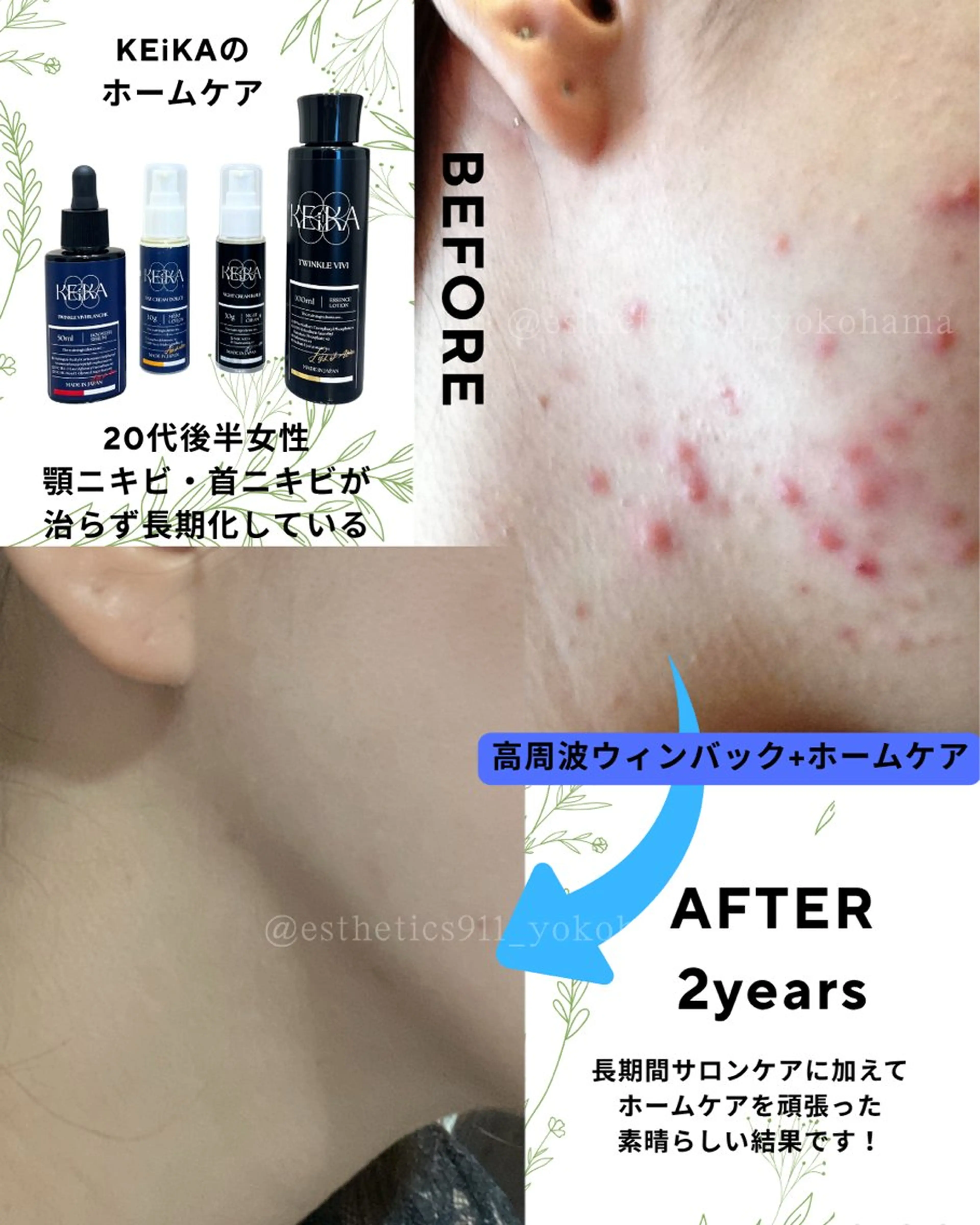 【お昼限定】肌荒れニキビ毛穴ケア！水素高周波のWアプローチ！フェイシャルエステコース初回の写真