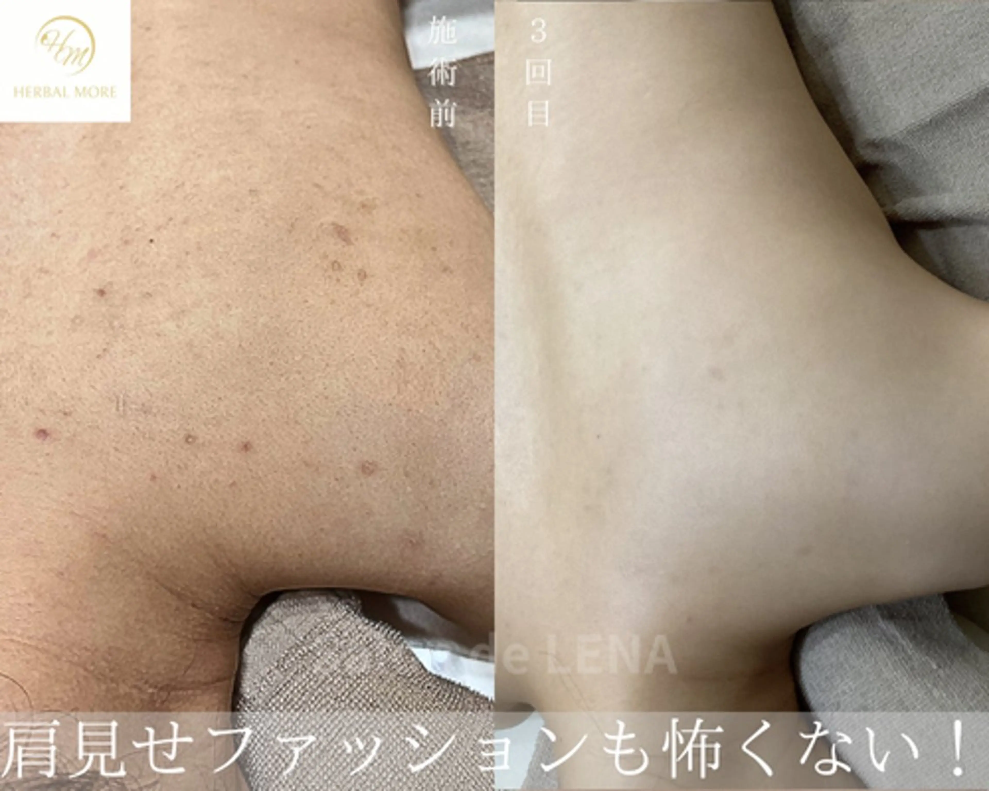 エステ サロンドレナ名駅店所属・ハーブピーリング専門 サロンドレナ平岡のエステ・リラクイメージ