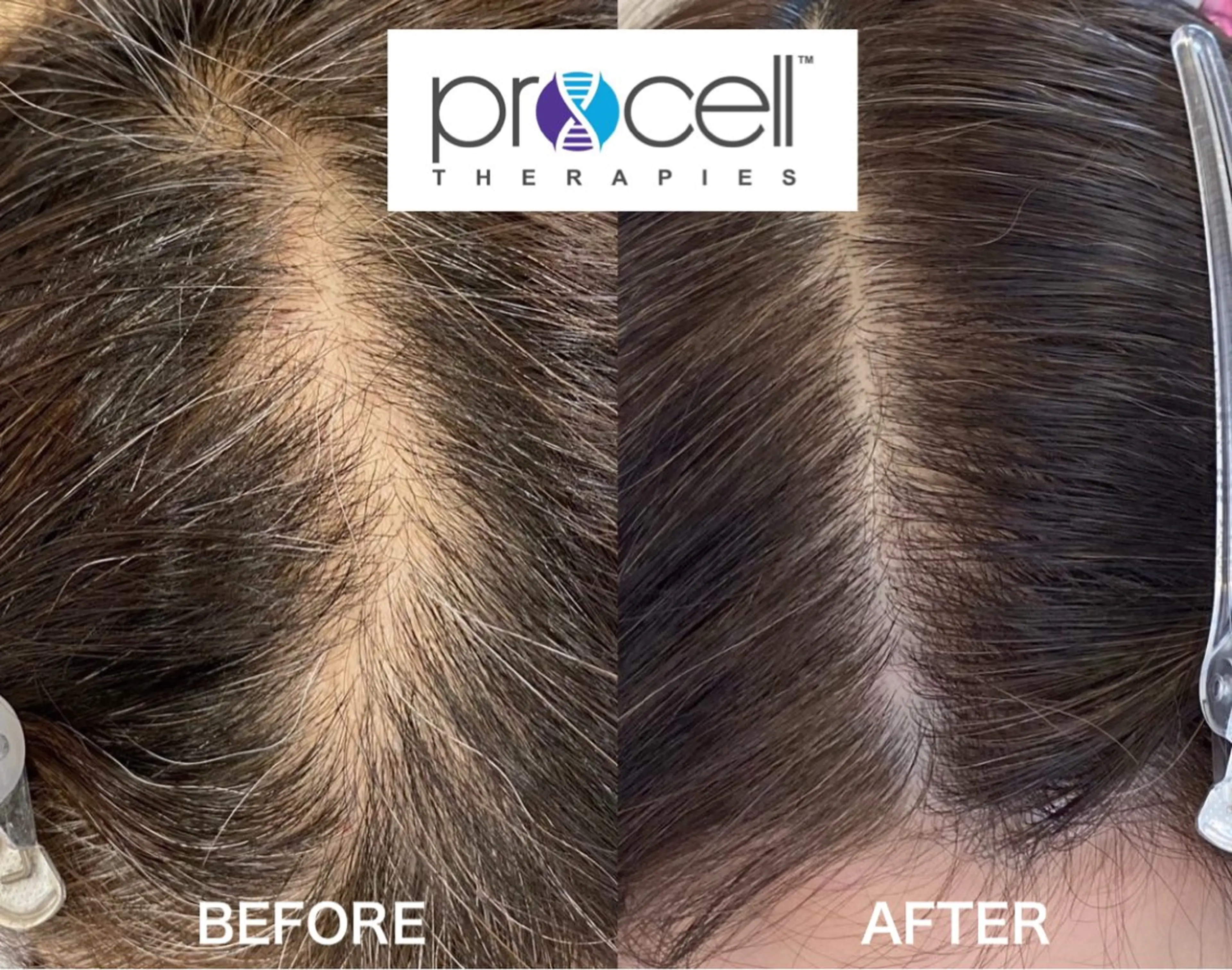 プロセルセラピーズ　頭皮ケアの写真