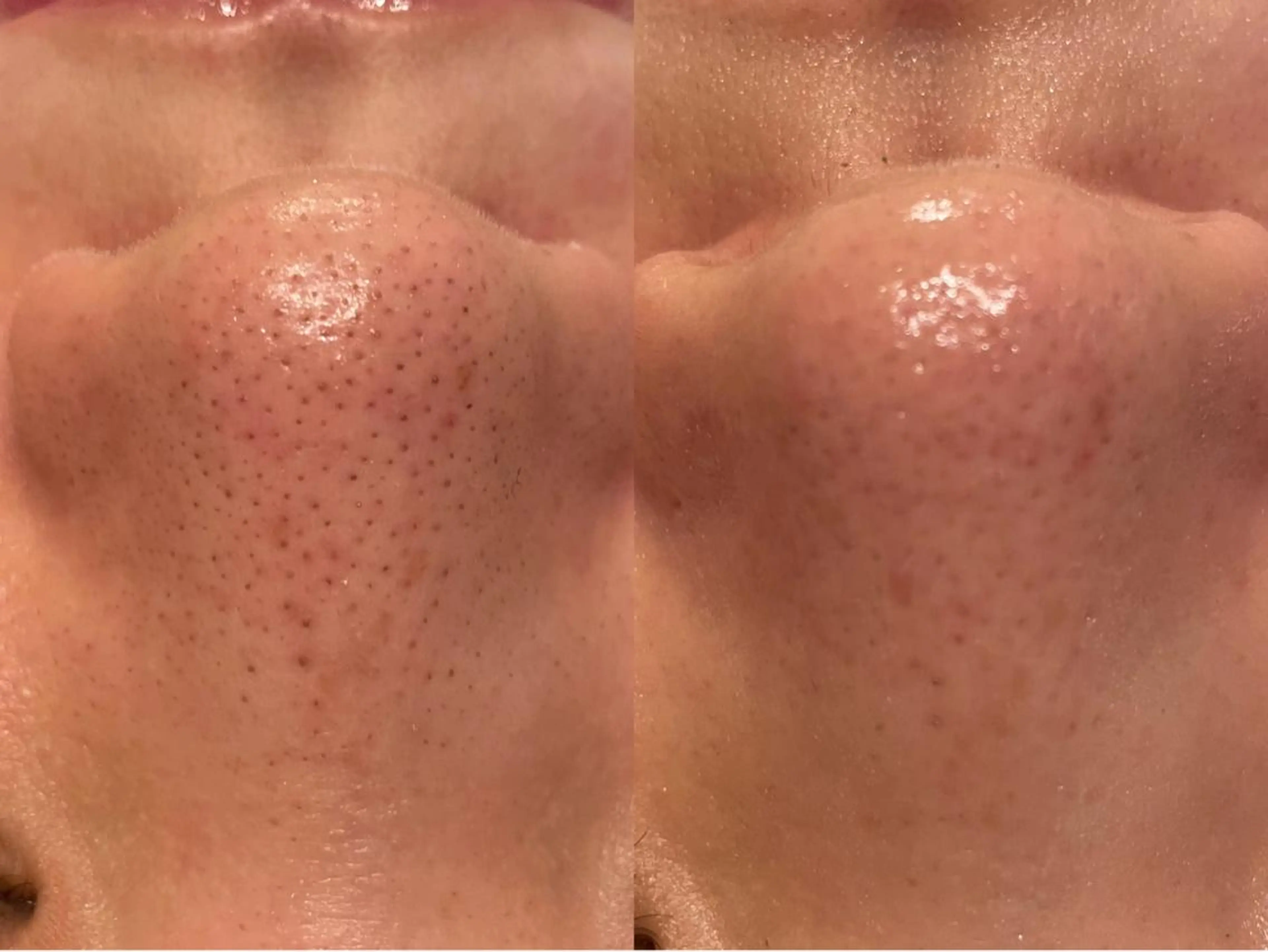 ミニモ初回限定価格！【結果重視】毛穴徹底洗浄×吸引×鎮静ケア※鼻のみの写真