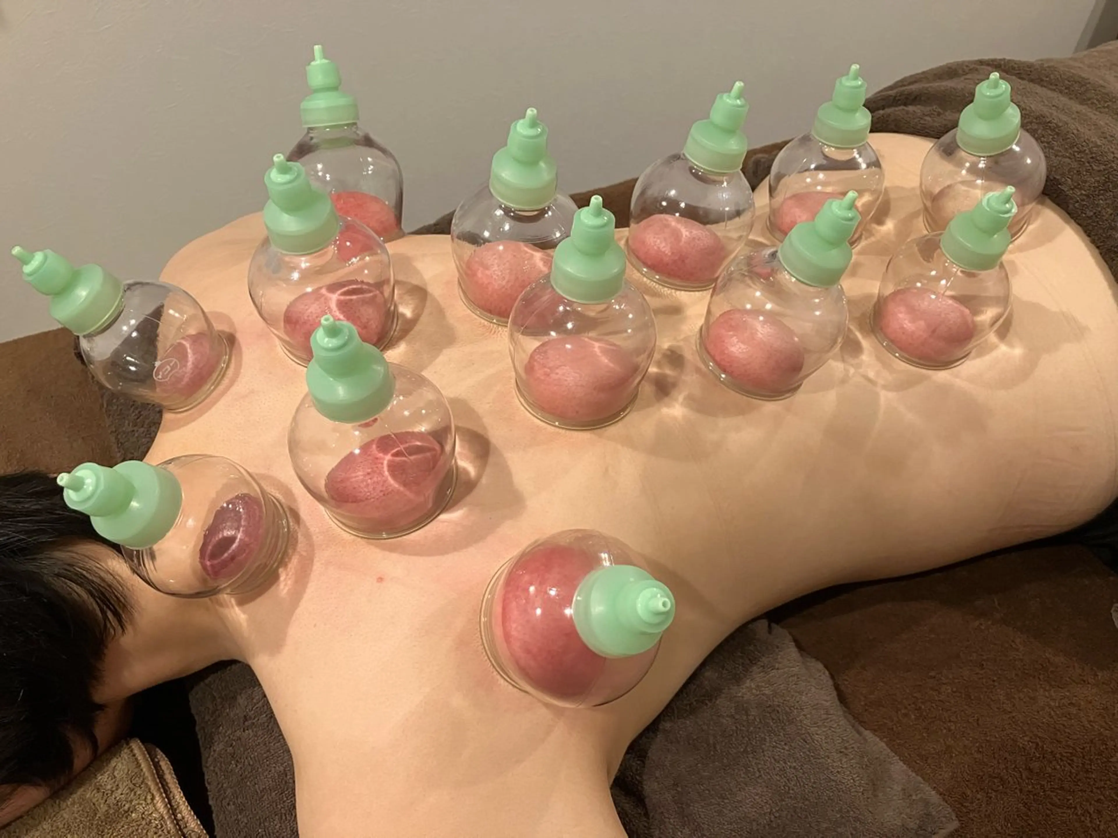 カッピング（吸い玉）orスライドカッピングの写真