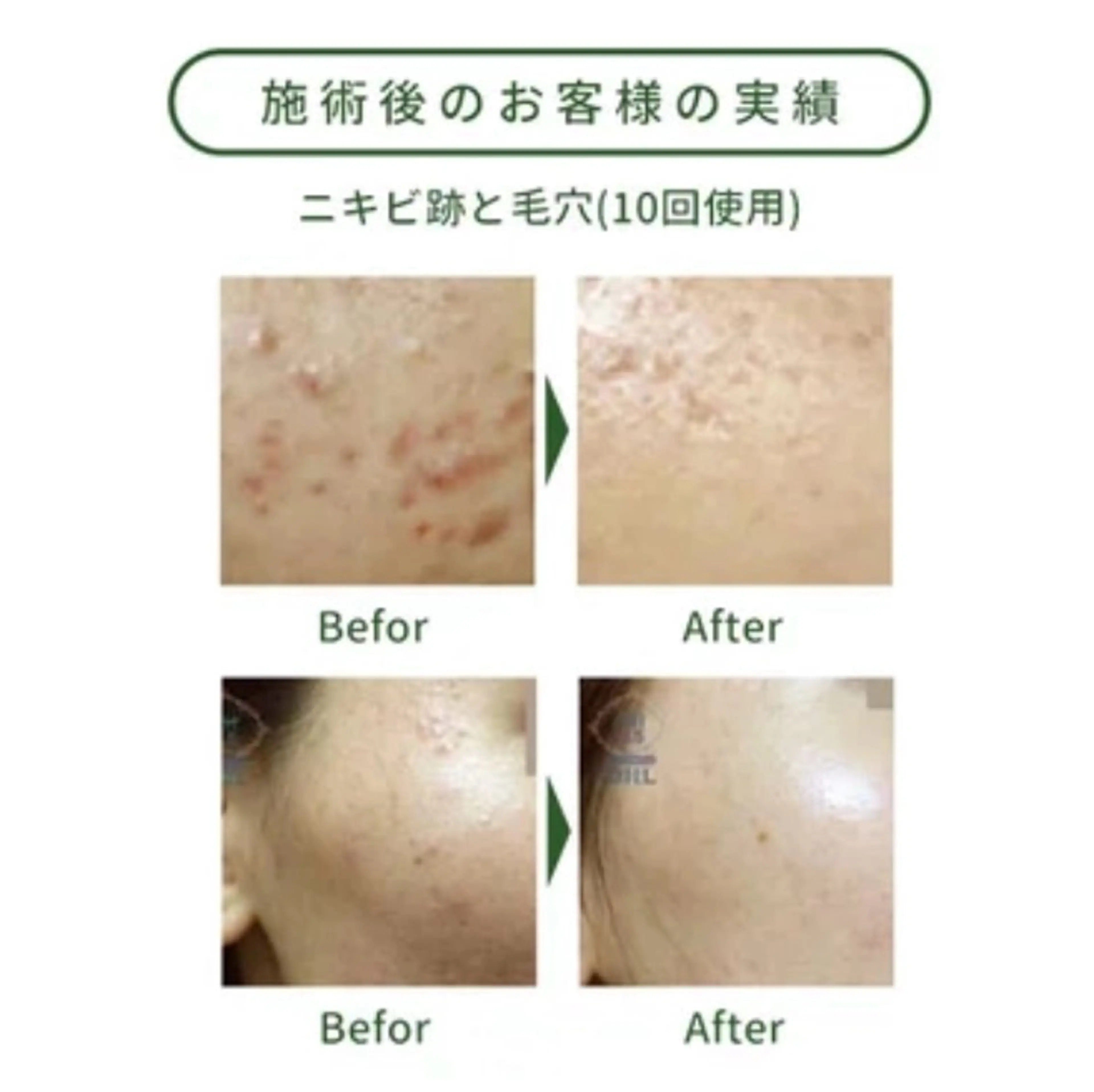 【人気NO1★専門家推奨】毛穴・ニキビ・美白・ハイドラ+ハーブピーリング+ヒアルロン酸+LED60¥26800→6500の写真