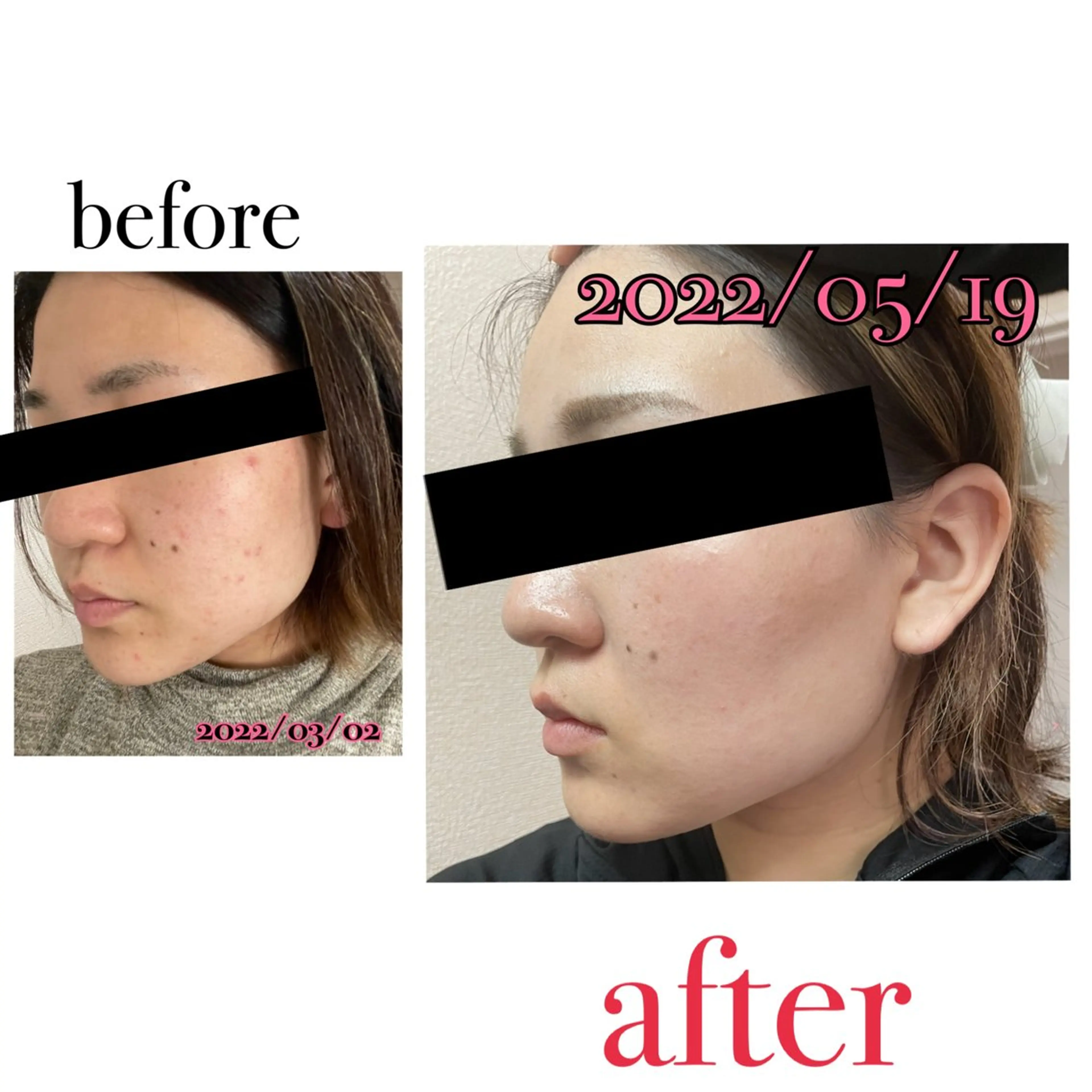 レディース脱毛　お顔脱毛の写真