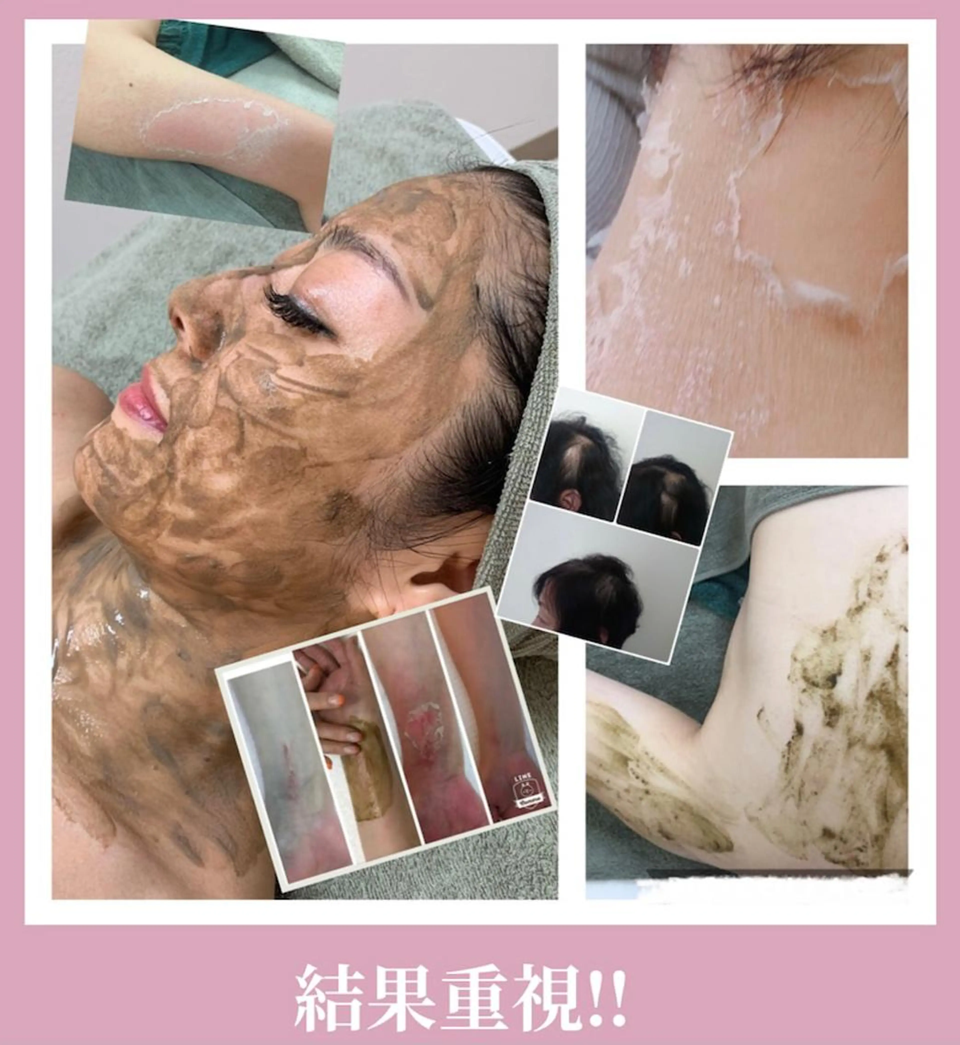 美肌整形✨ 『Lv 5ハーブピーリング』剥離タイプ❣約5日間で整肌★Afterトリートがセットになった2回コースです🥰の写真