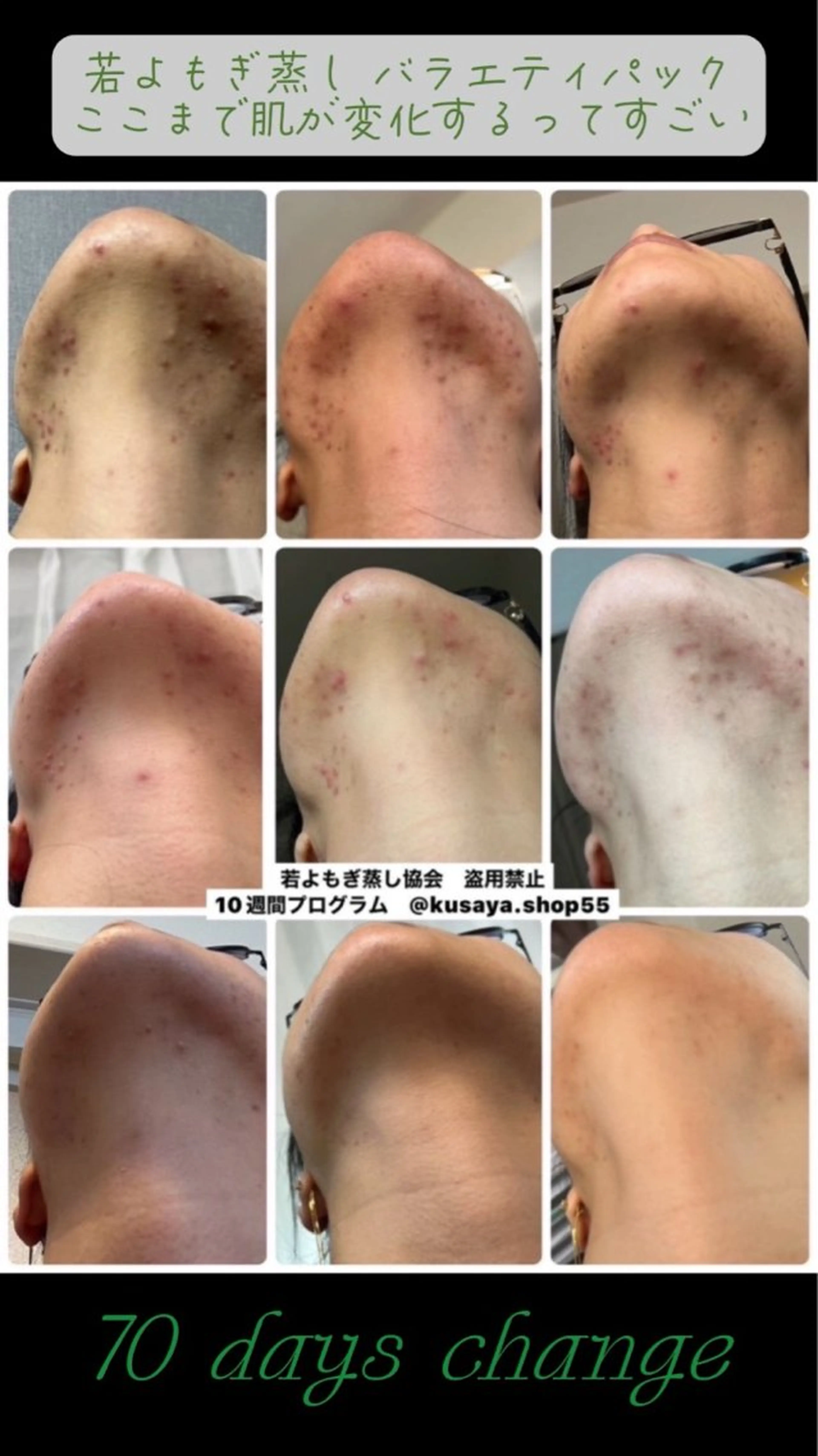 若よもぎ蒸し⭐︎集中ケアコースの写真