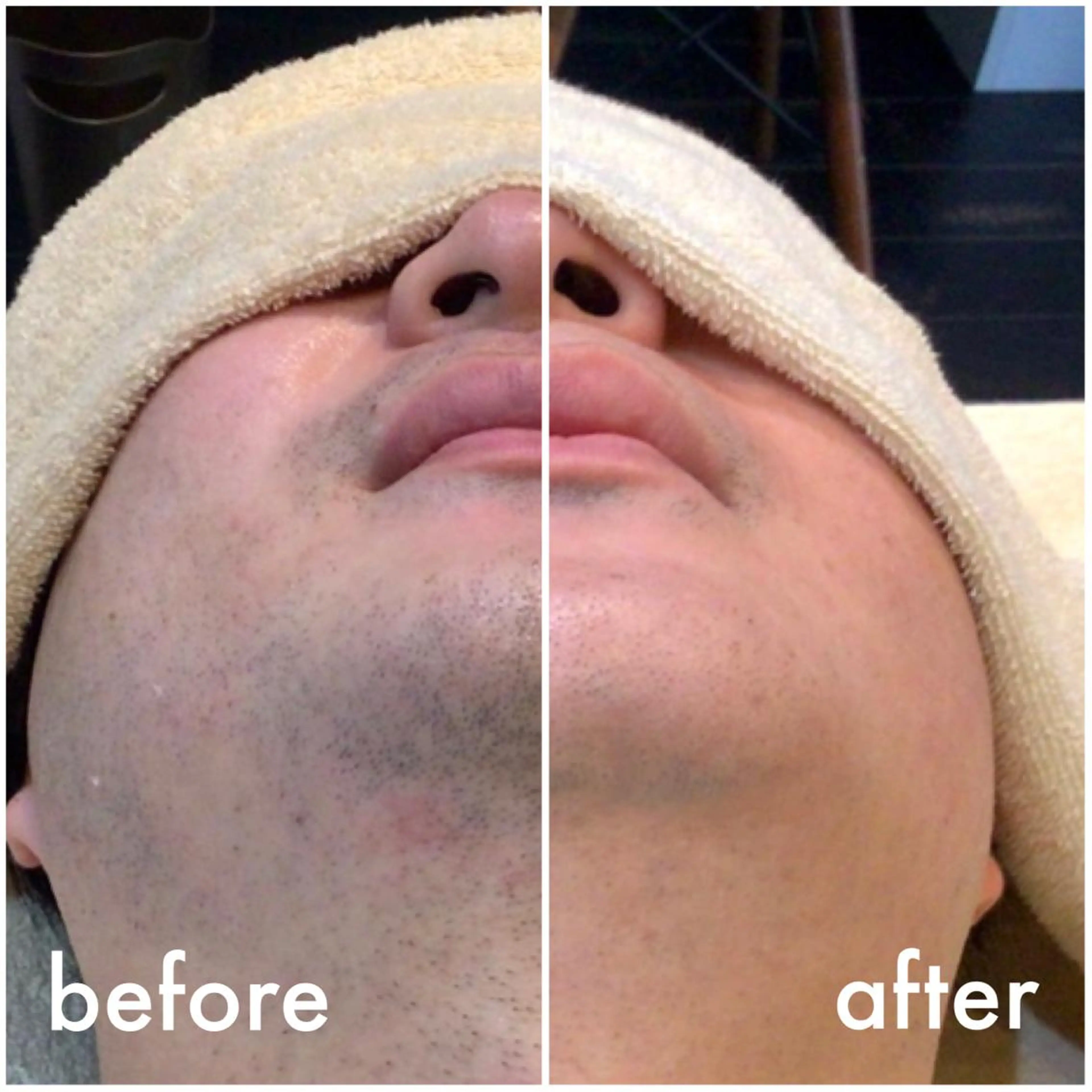 ひげ脱毛の写真