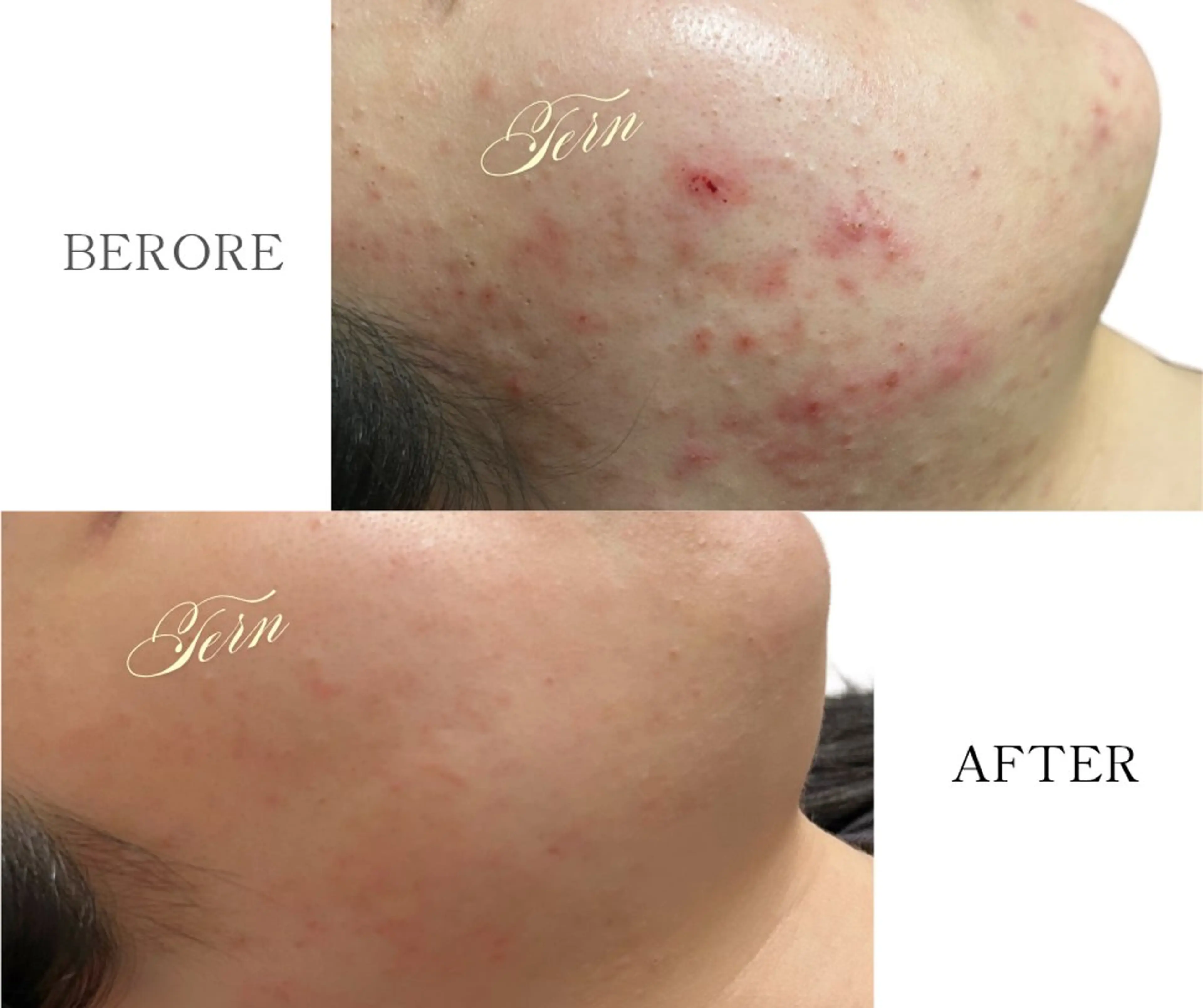 小顔・ニキビ・肌管理 TERN 南草津店のエステ・リラクイメージ