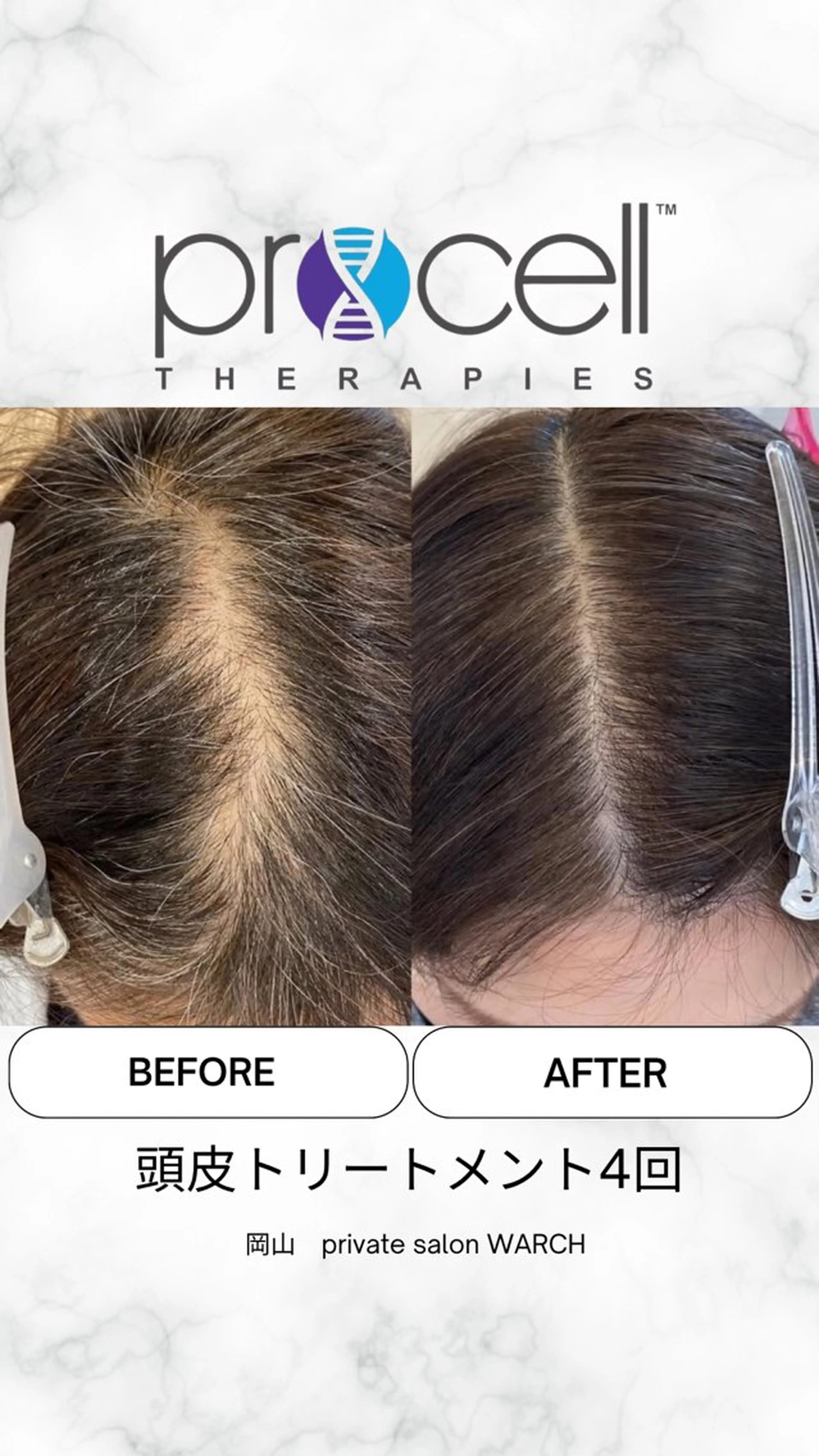 【本気の育毛促進】プロセル頭皮（分け目の毛量アップ）￥50,000→￥40,000の写真