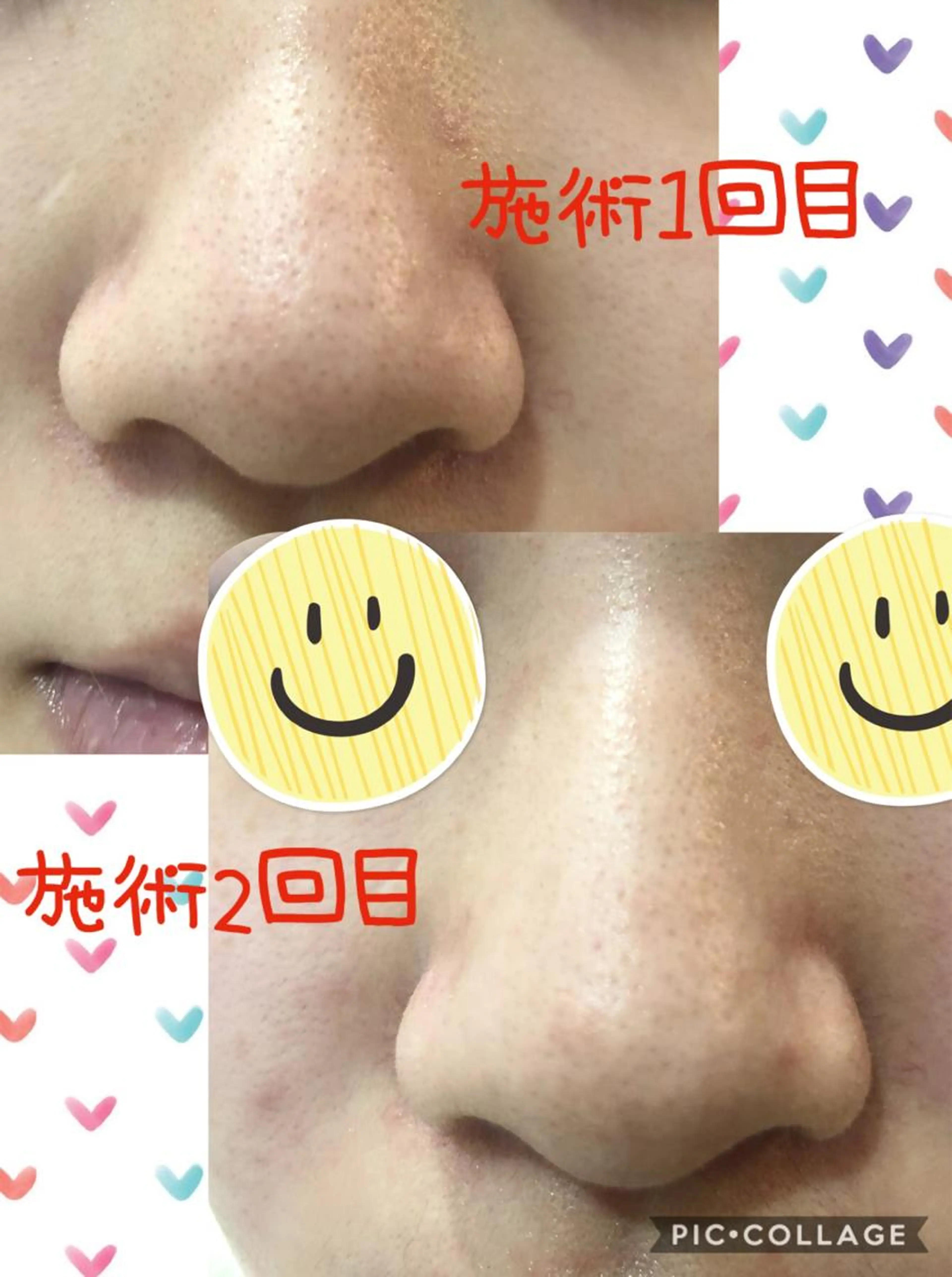 【毛穴吸引&フェイシャルベーシック🍀】気軽にお手入れをしたい方にオススメ🥰ストレス解消にリラックス🌈の写真