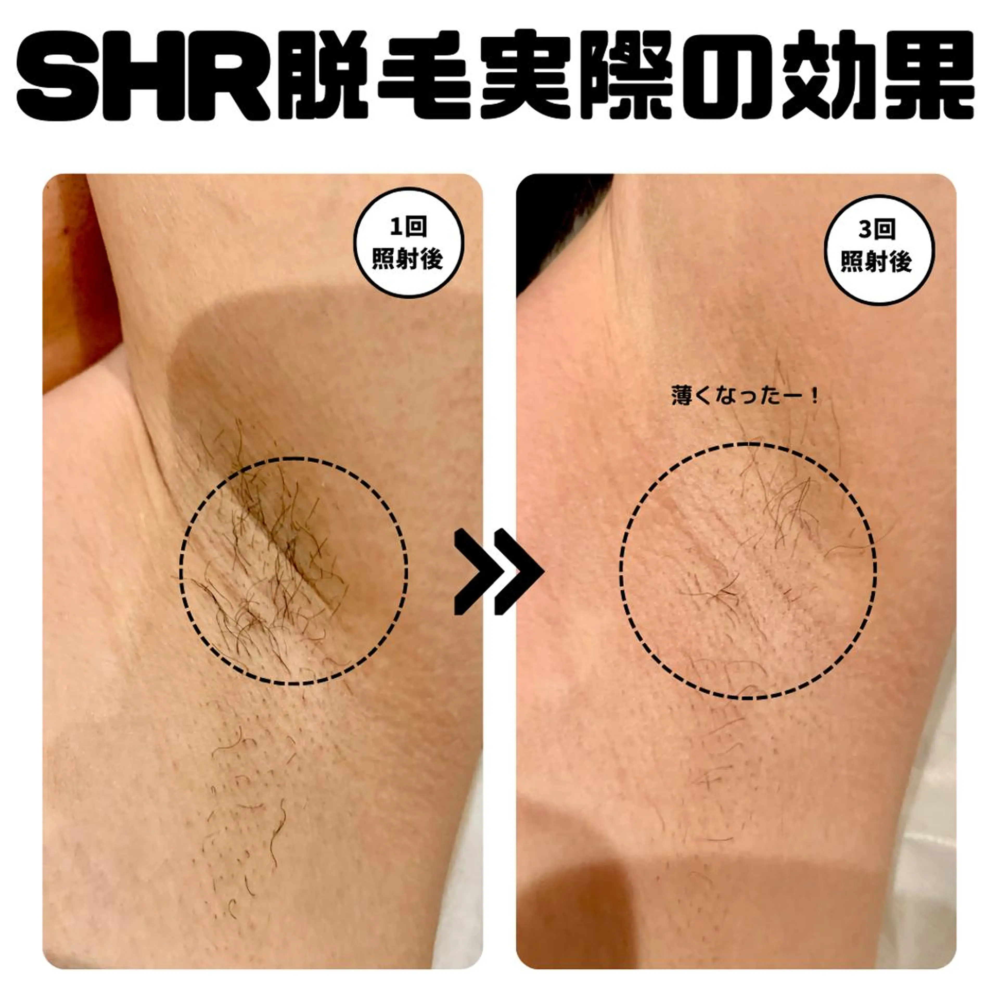 男性におススメ💪🏻「濃い毛に効くしっかり効く！」おヒゲIPL脱毛￥3,980の写真