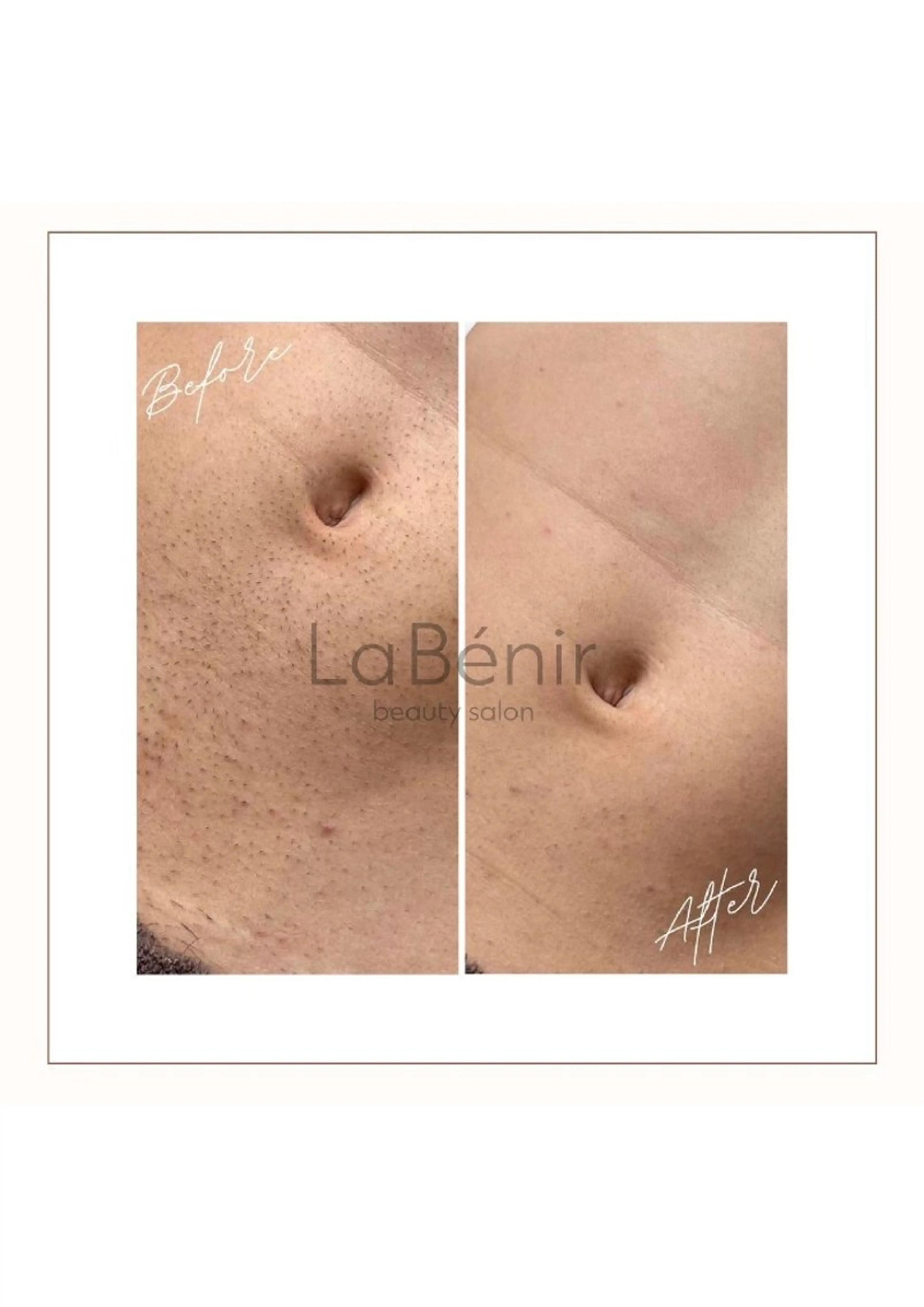 メンズ 脱毛 脱毛/美肌【皮膚科看 護師経営】ラベニールのエステ・リラクイメージ