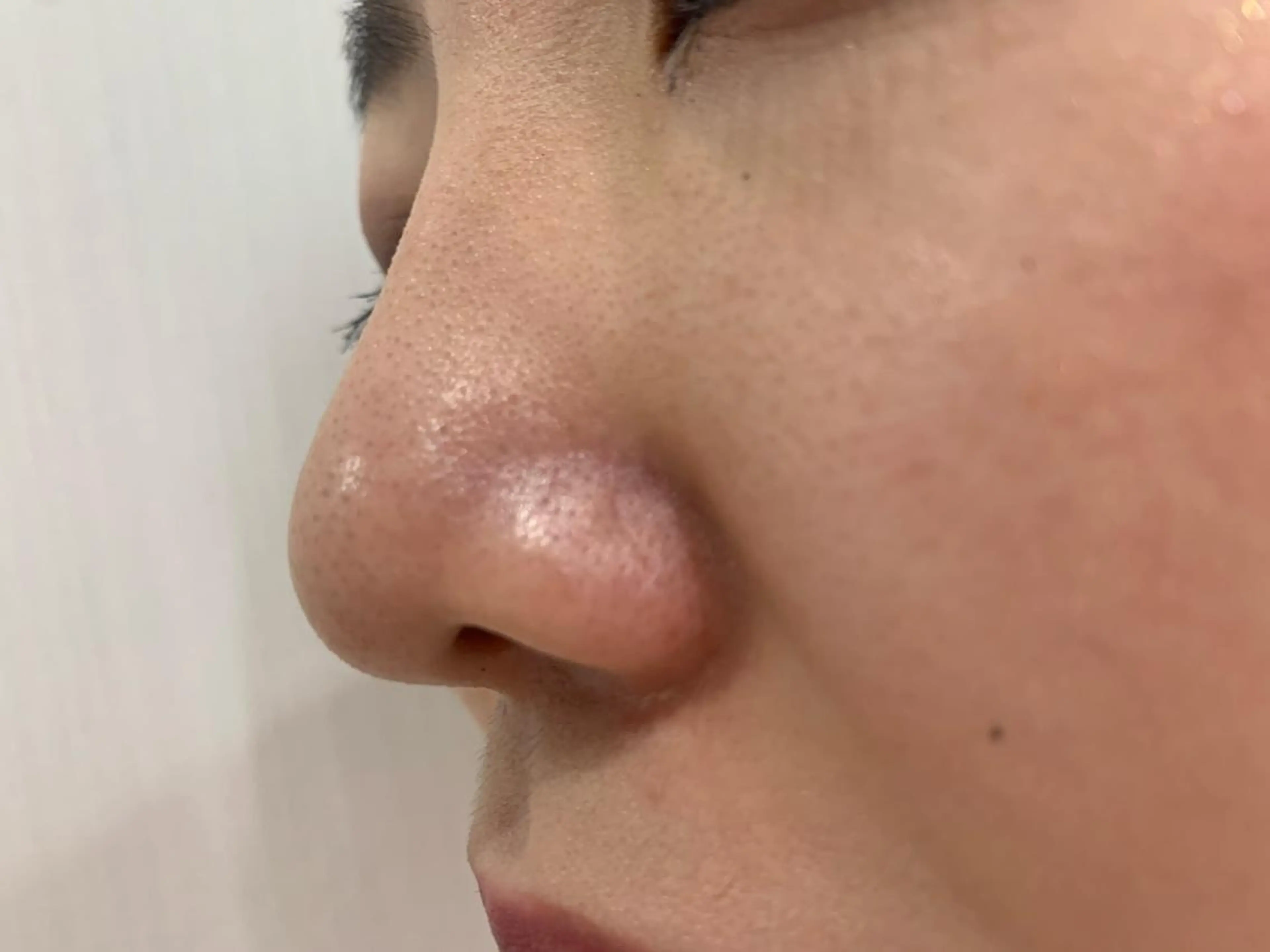 エイジングケアコース➕毛穴パック サロン人気No.1❤️マスクで毛穴が目立つ方への写真