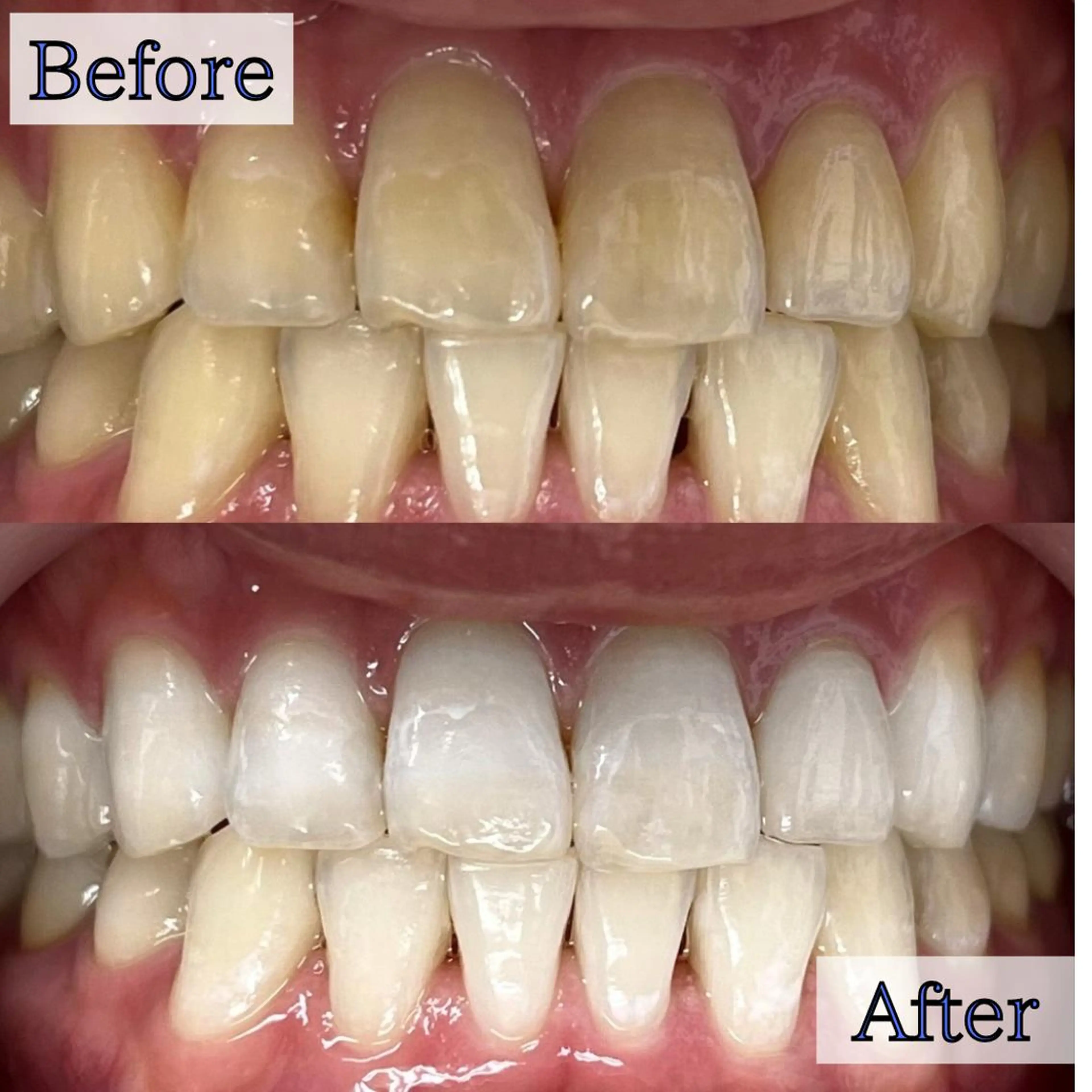 その他 LBSホワイトニング 新宿店💝公式のその他イメージ