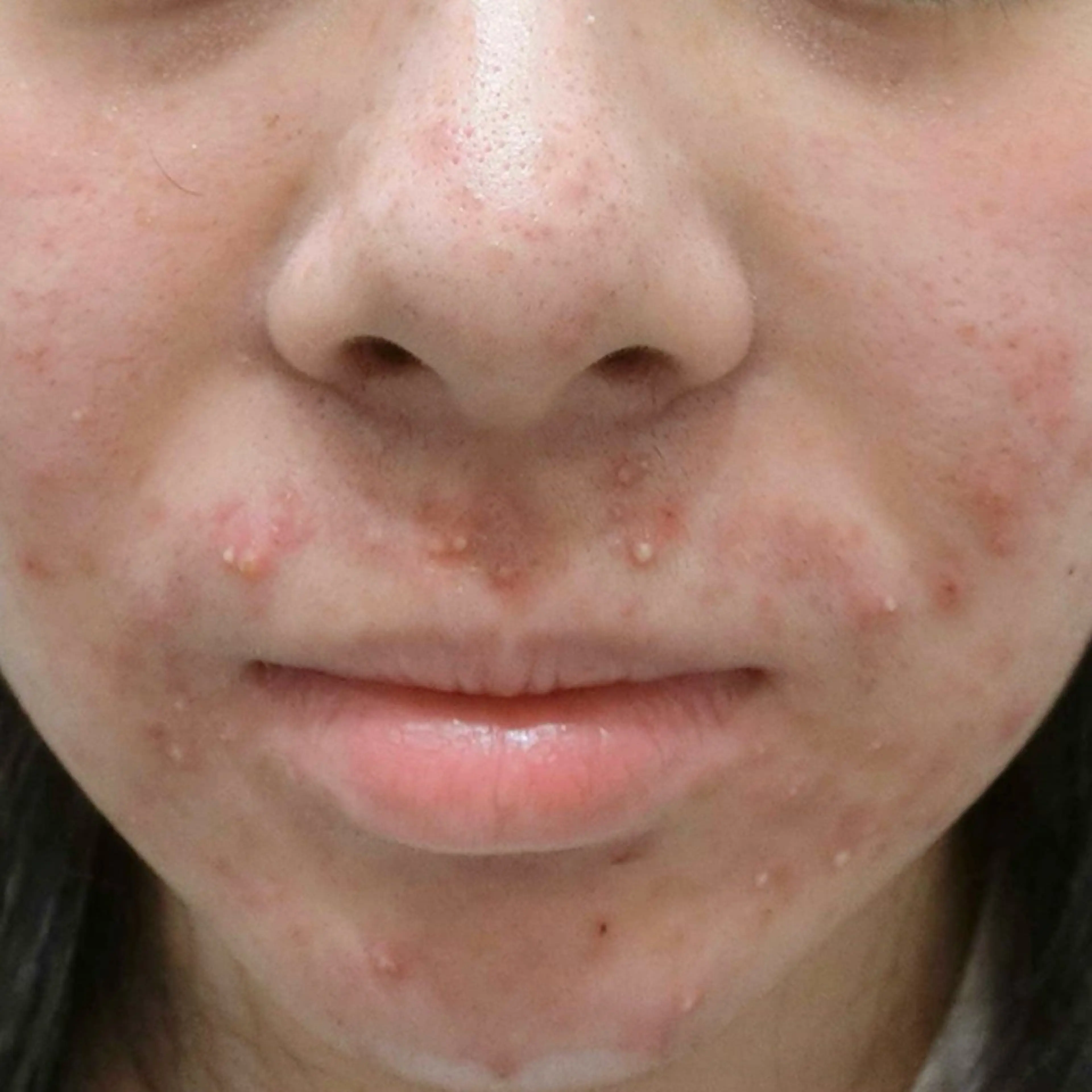 ＼SOS‼︎ ニキビ悩みに集中ケア✨／「すぐ治したい…」「繰り返してつらい…」そんなお悩みにしっかりアプローチ！の写真