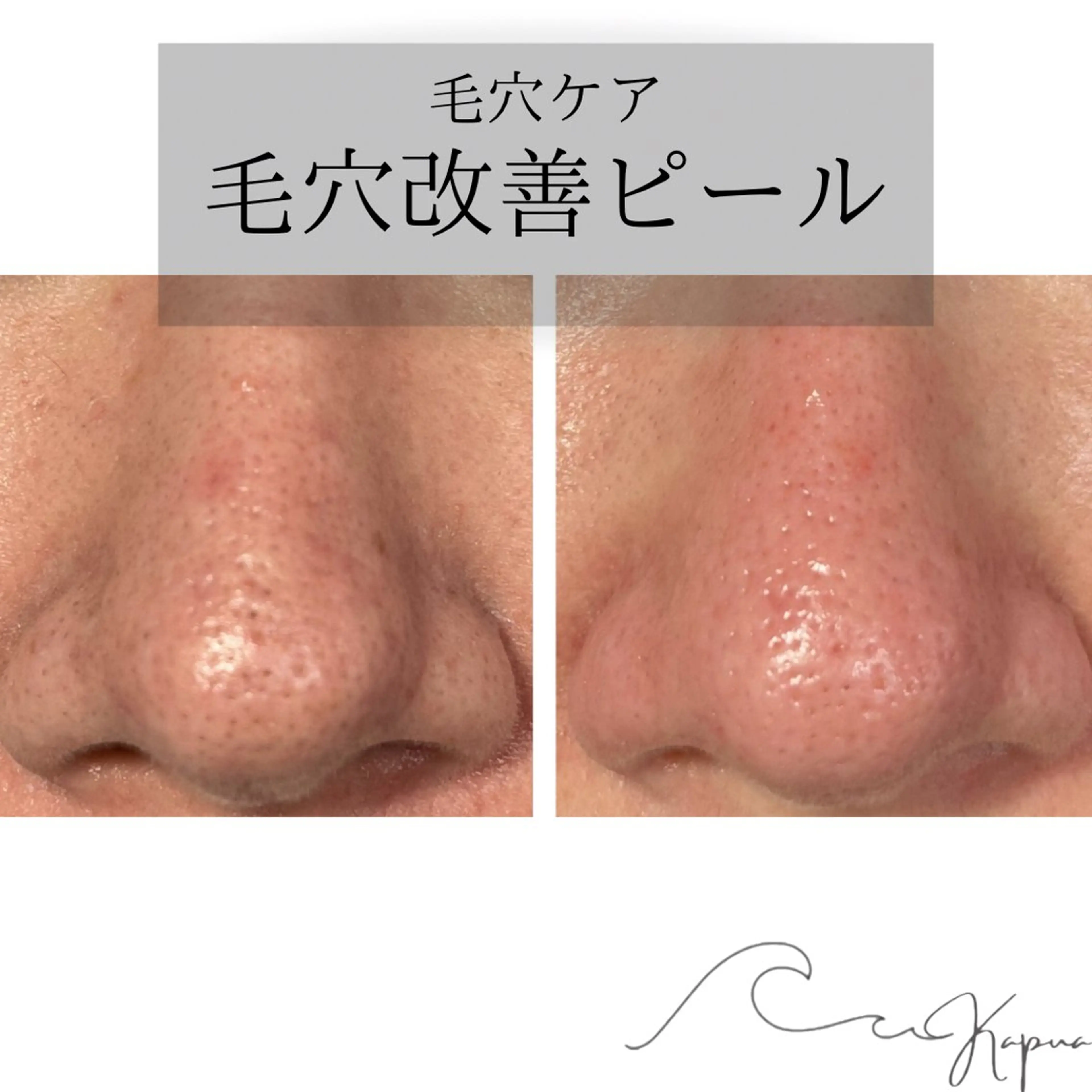 🟢毛穴改善ピール🔵鼻のみの写真