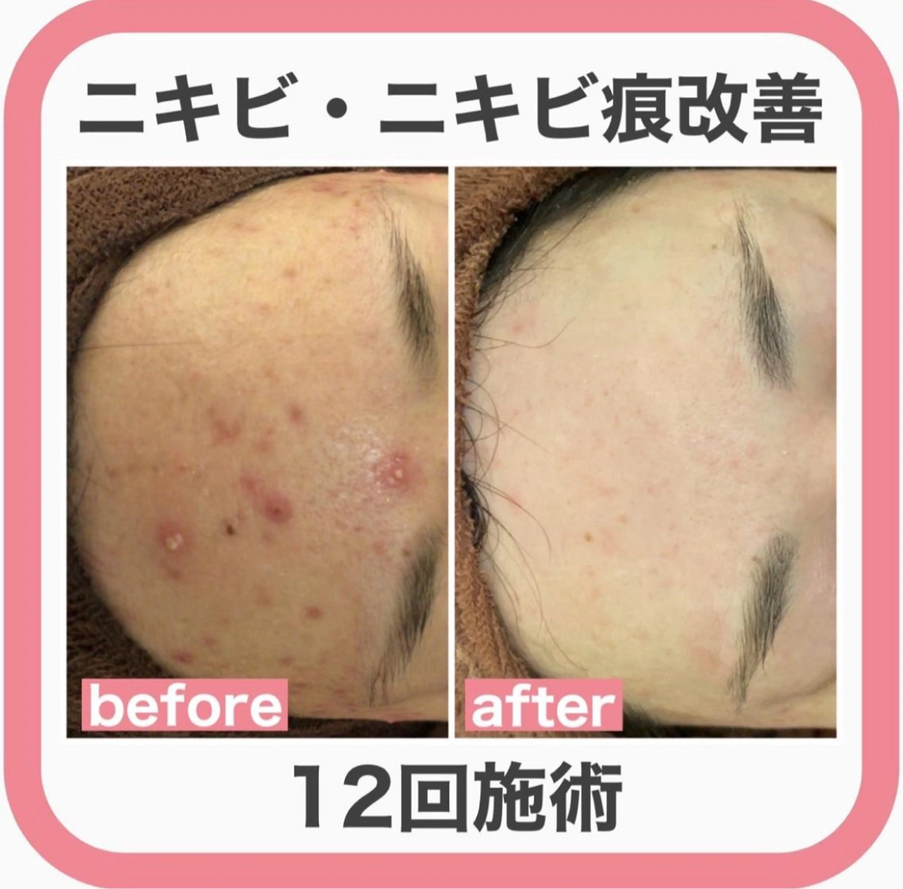 学生ニキビ改善🍀 優しい肌質改善のエステ・リラクイメージ