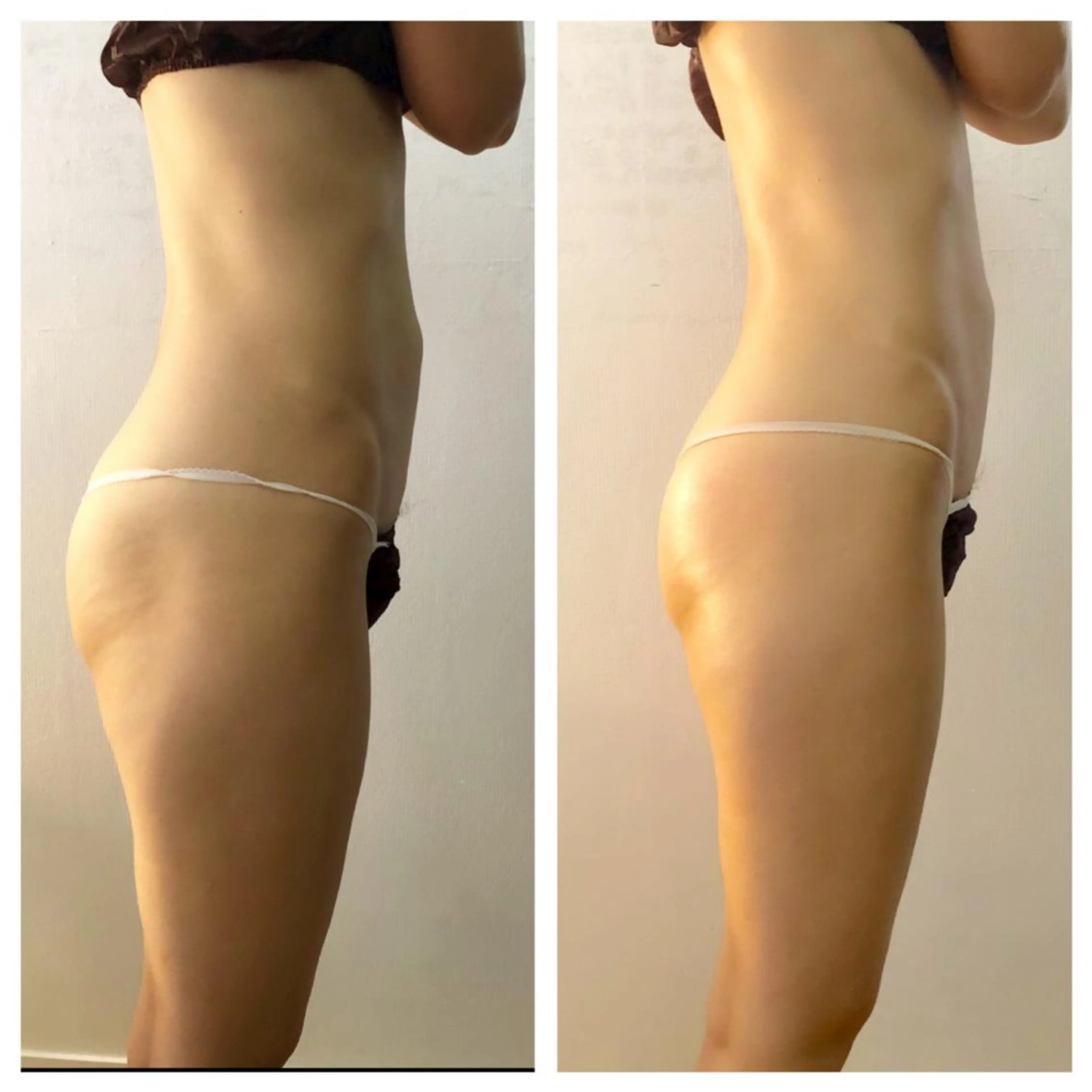 🔥 部分痩身 60分）｜深部温熱ラジオ波×熟練ハンドで集中ラインケアの写真