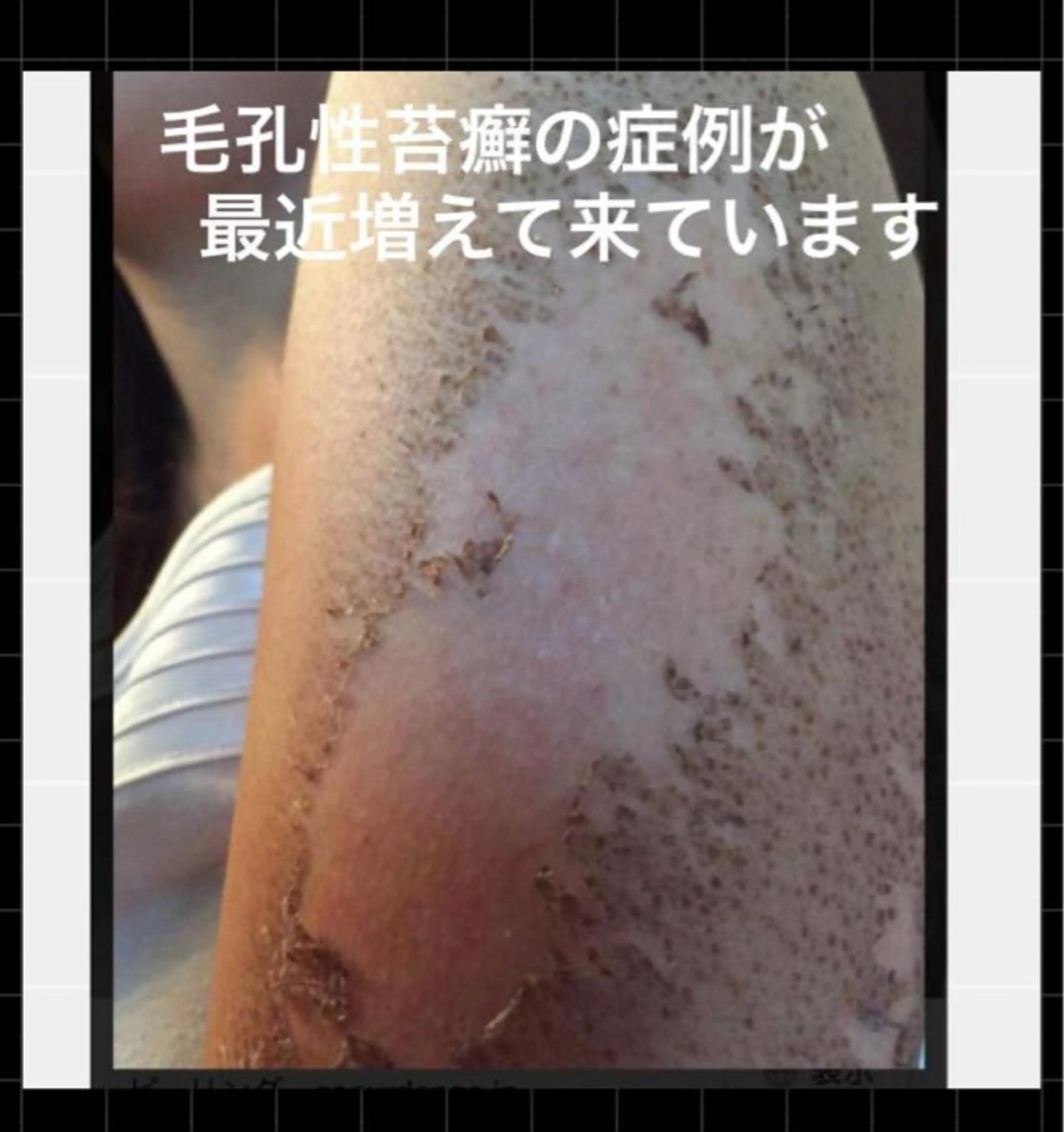 エステ ハーブピーリング 専門店MOKA所属・ハーブピーリング専門 MOKAのエステ・リラクイメージ