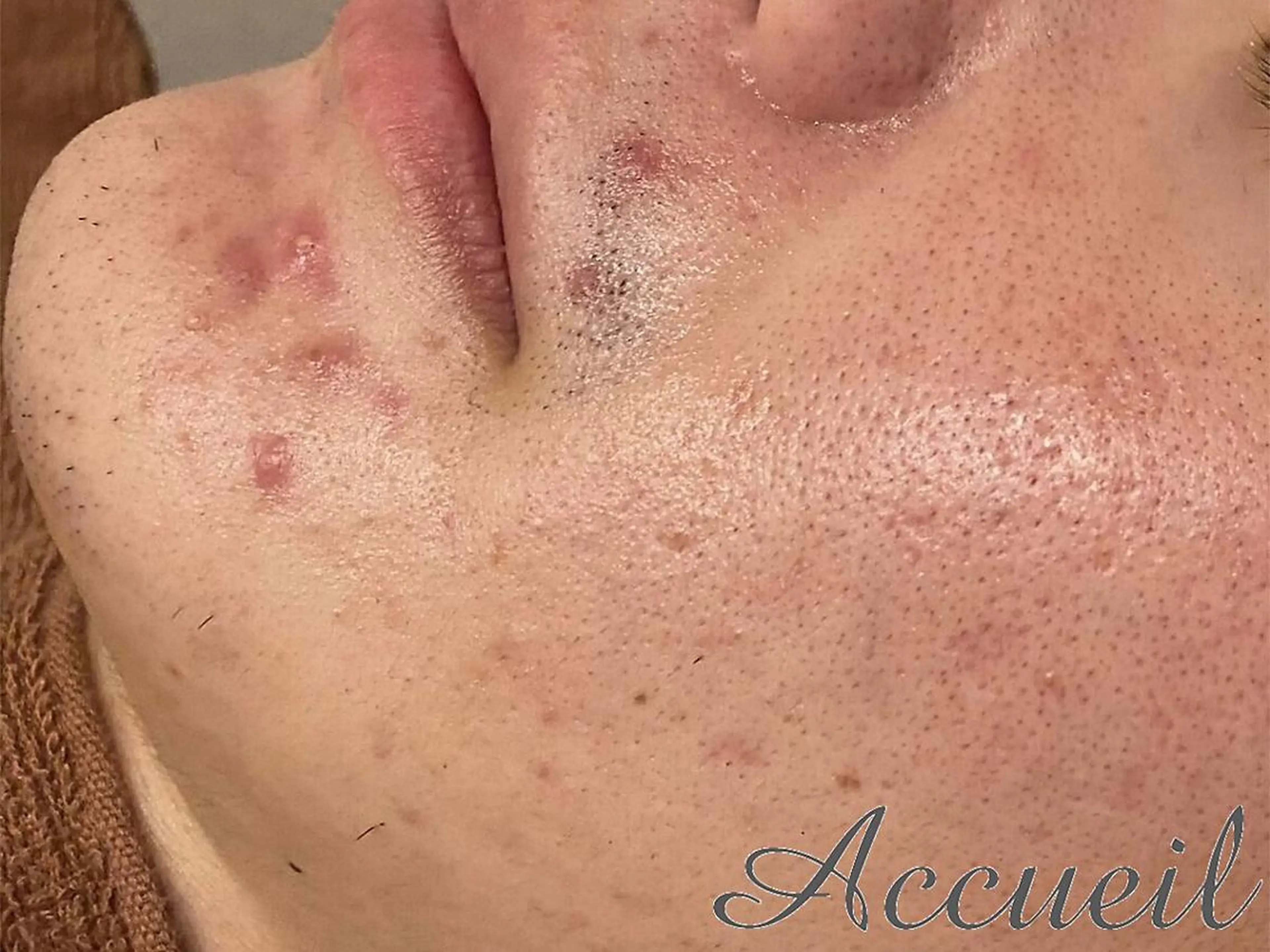 🔥3か月で肌革命 🔥ニキビ専門店のエステ・リラクイメージ