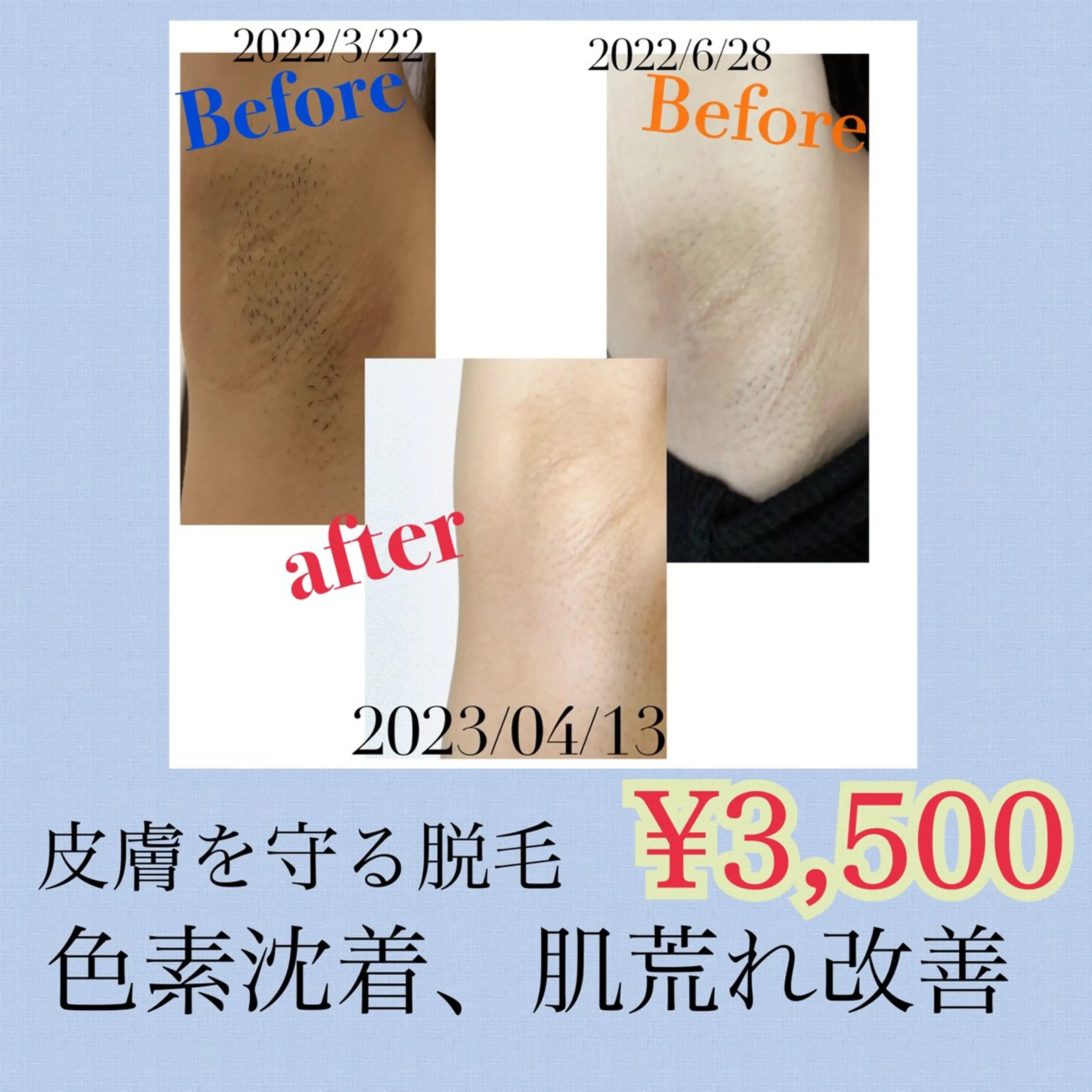 レディース脱毛　VIO脱毛の写真