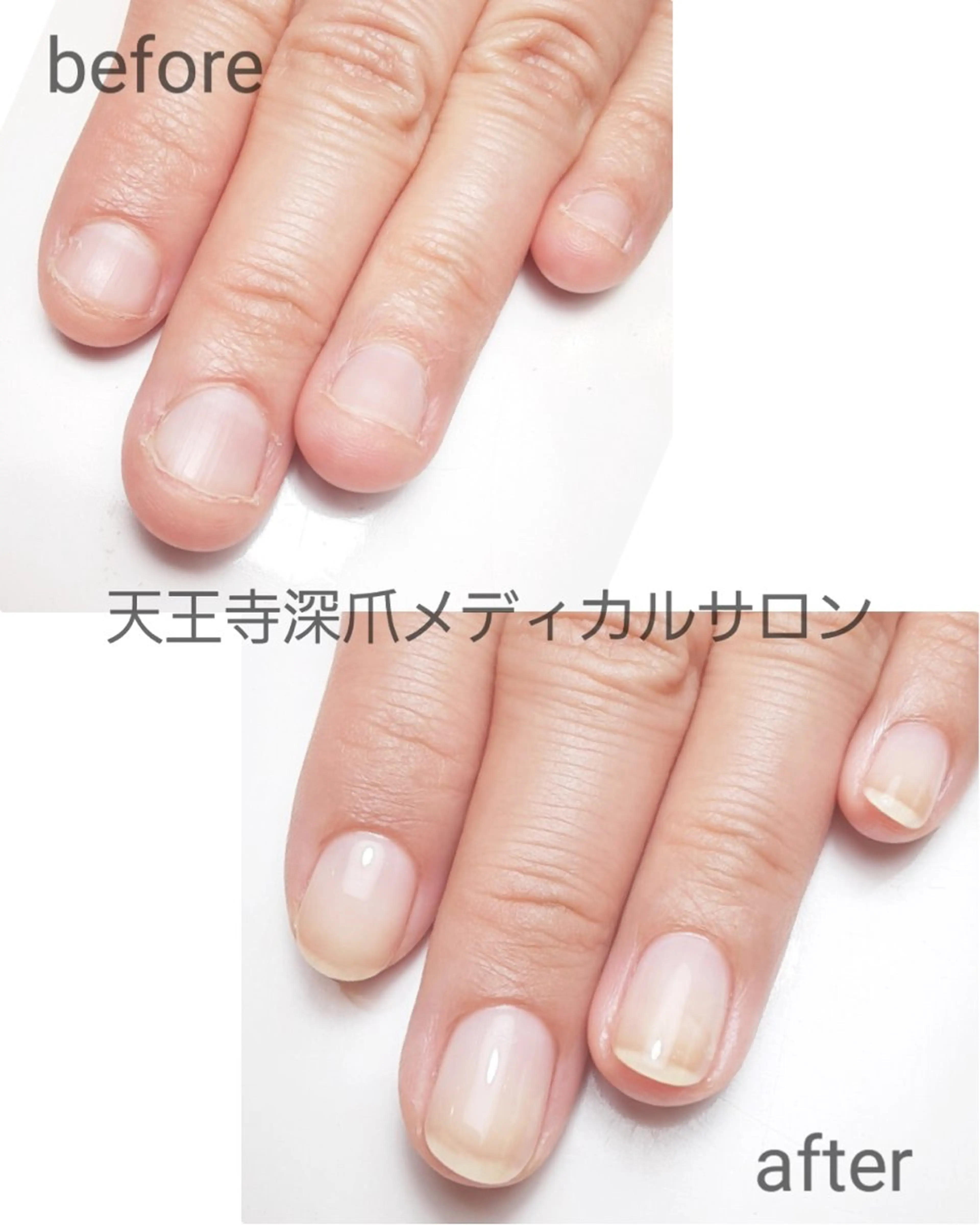 ネイル 天王寺 深爪メディカルサロンのネイルデザイン