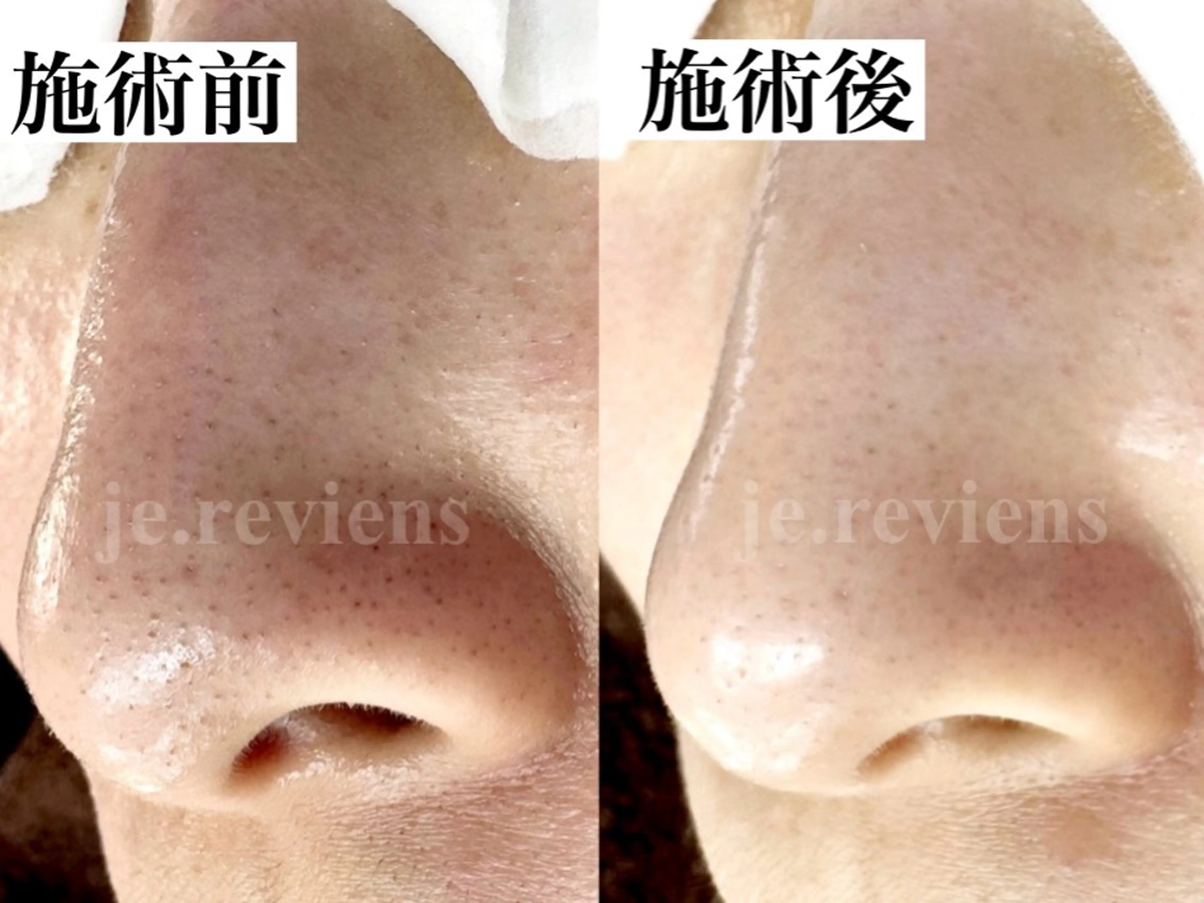 毛穴の詰まり黒ずみに！毛穴洗浄（クレンジング、マッサージ込み）の写真