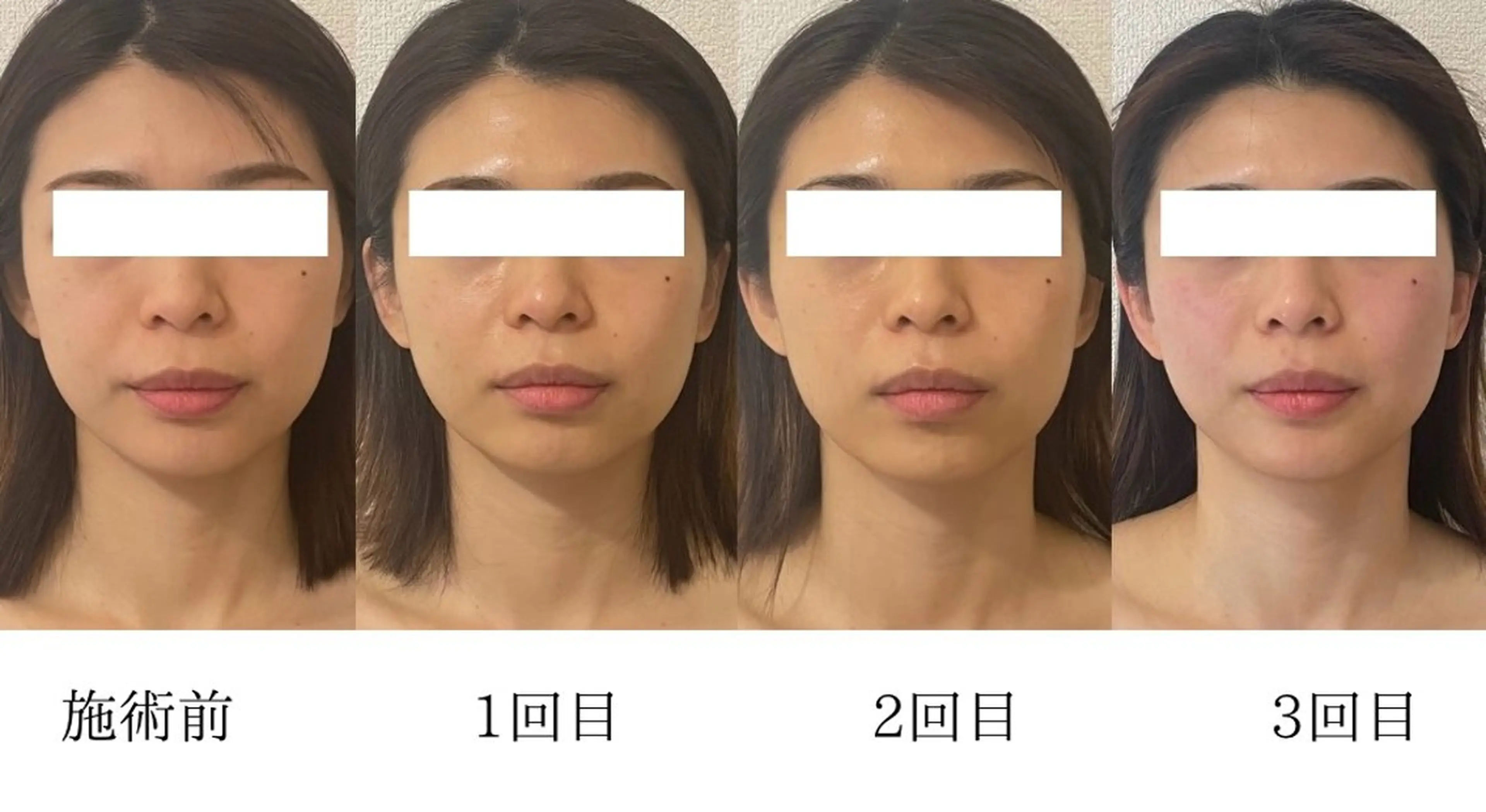 エステ 小顔/たるみ/黒ずみ除去専門サロン/SONA 大和西大寺店所属・【小顔専門看護師 サロンSONA】のエステ・リラクイメージ