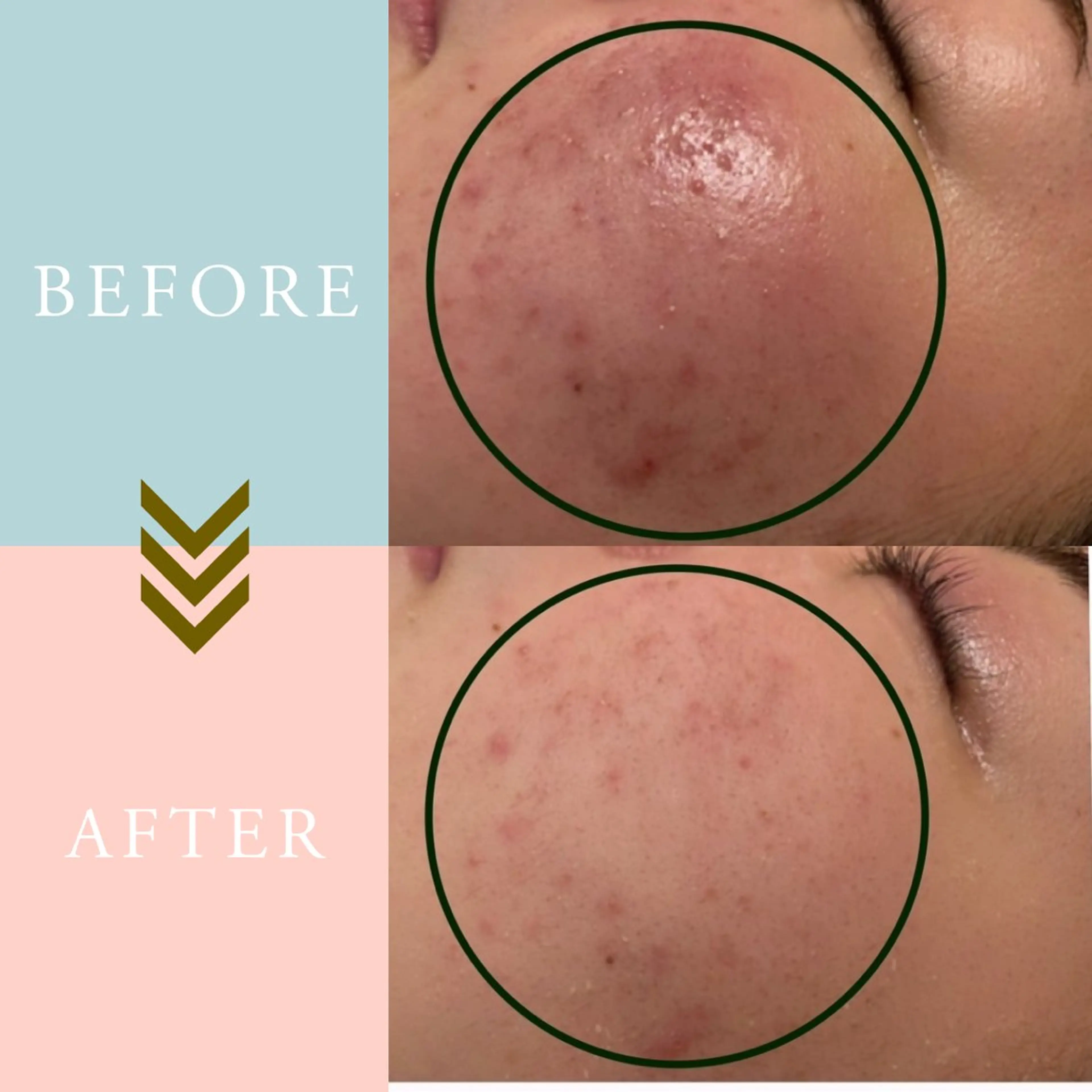 キッズ ニキビケア/毛穴/ 赤み/自信の肌✨森園のエステ・リラクイメージ