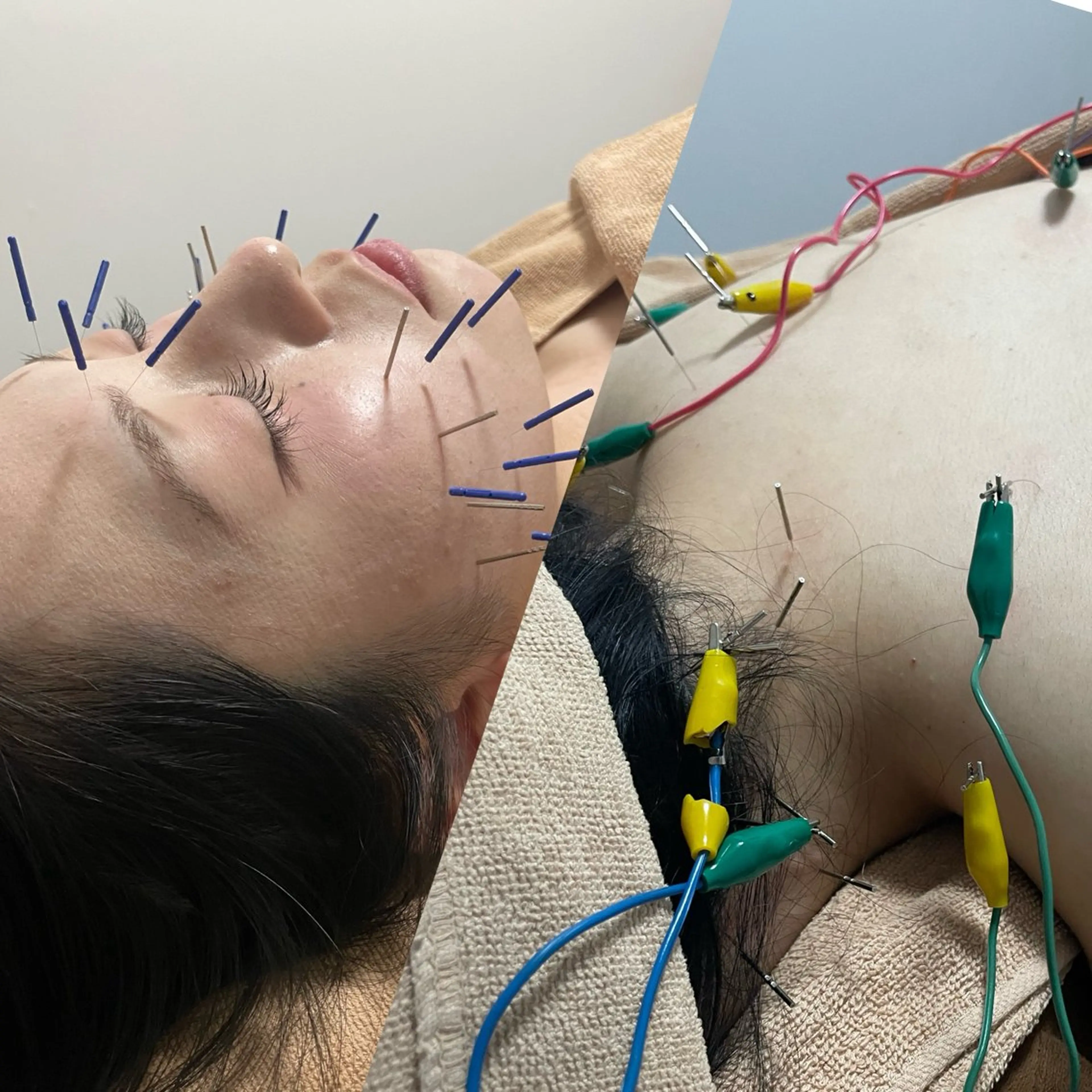 美容鍼/鍼灸 ここみ鍼灸院のエステ・リラクイメージ