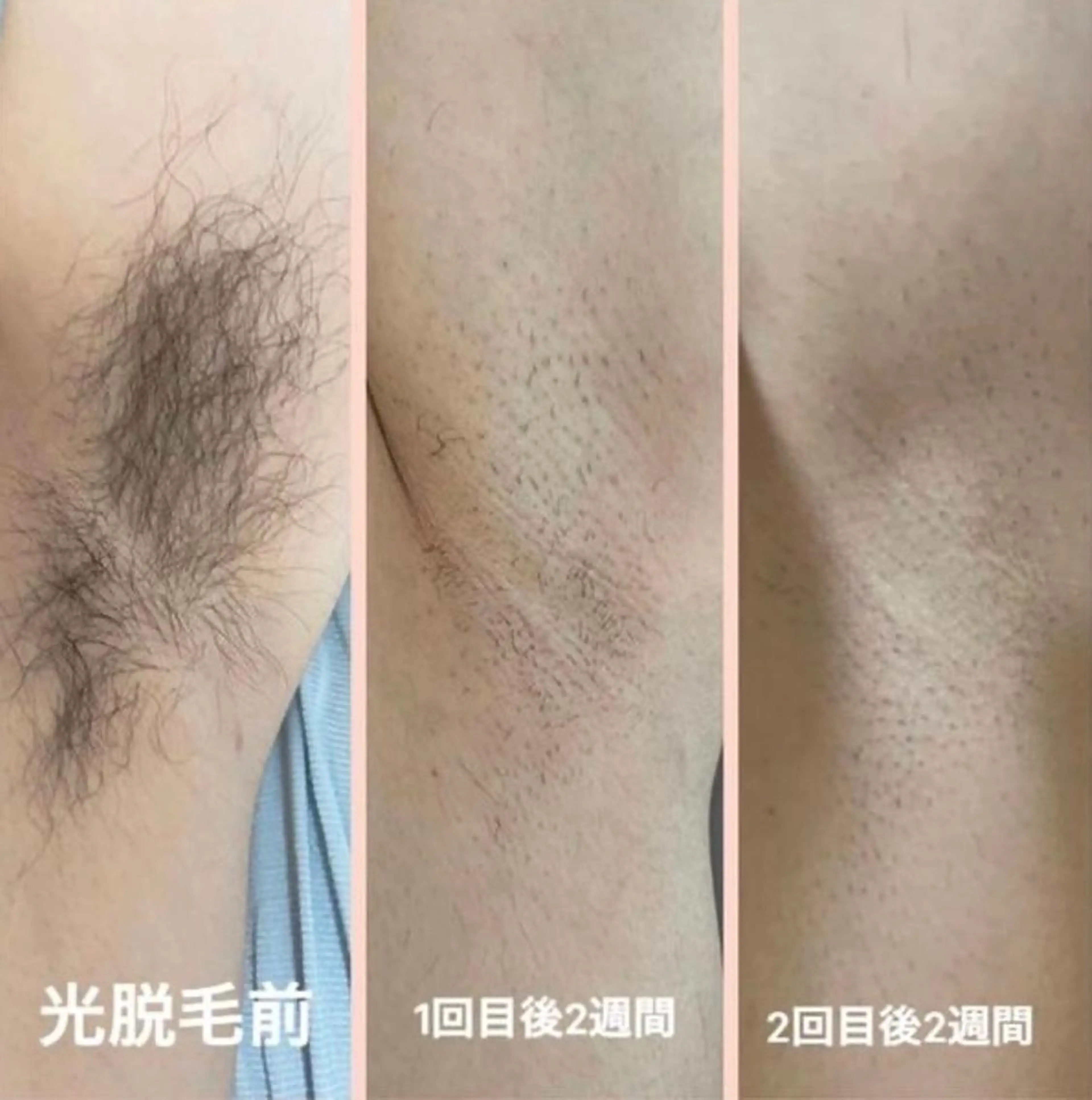 キッズ 脱毛 美肌脱毛サロンGrande所属・別府脱毛サロン Grandeのエステ・リラクイメージ