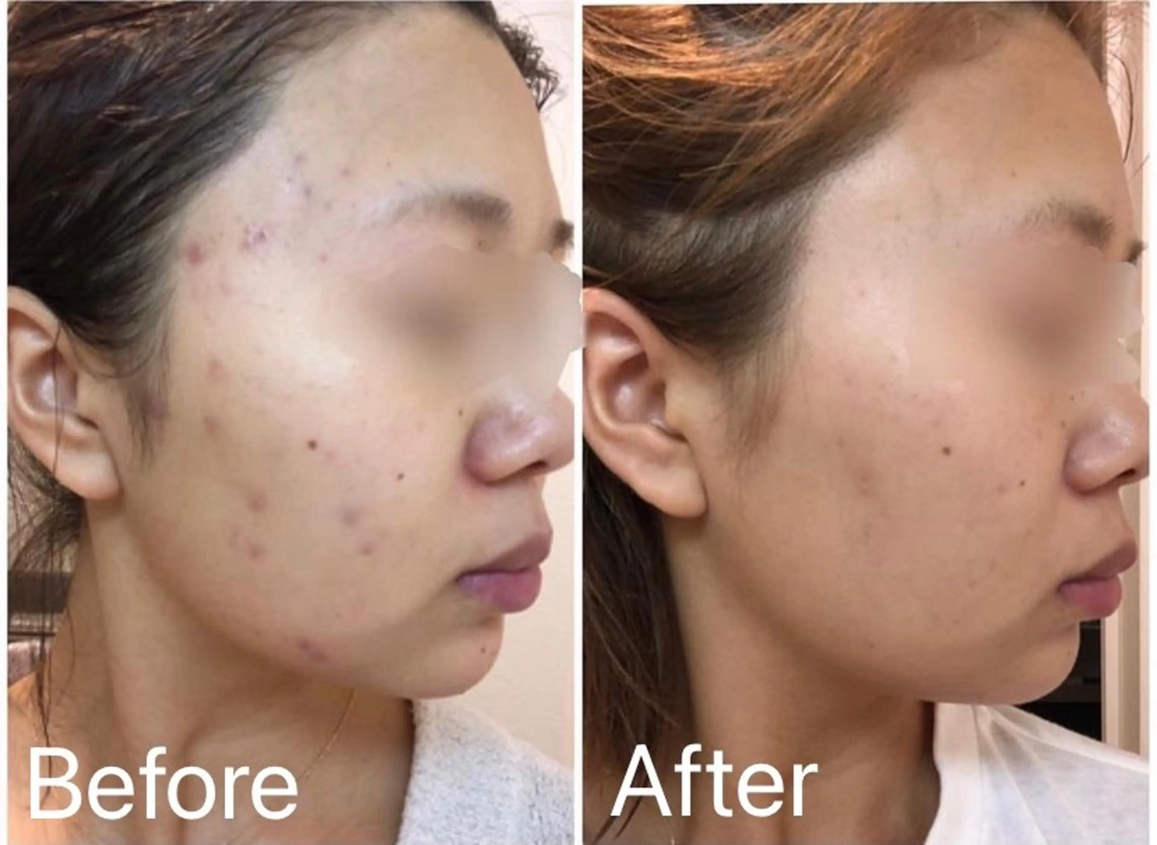 肌結果をお約束フェイシャルエステ《FAITH生コラーゲン5ステップ》の写真