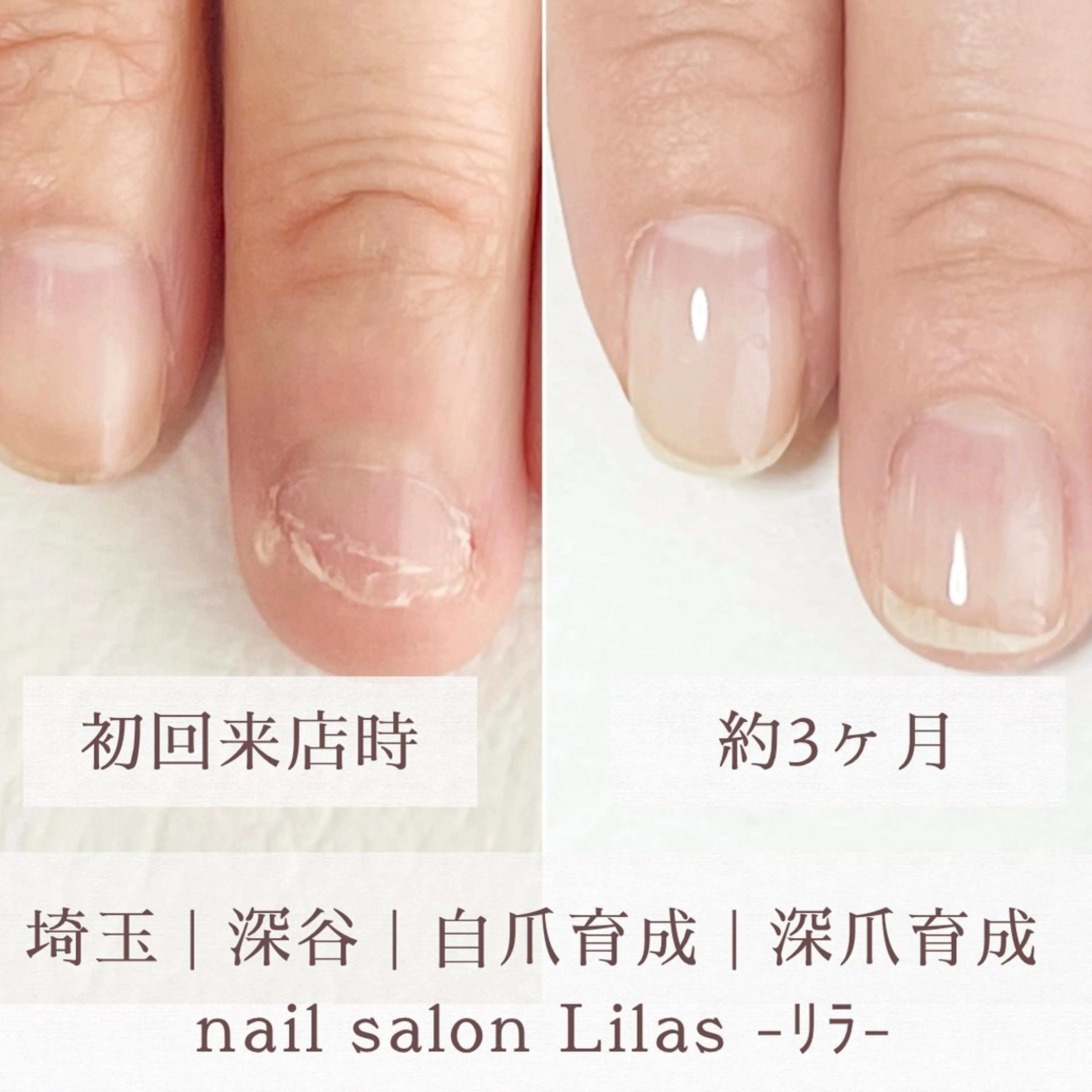 深爪育成の写真