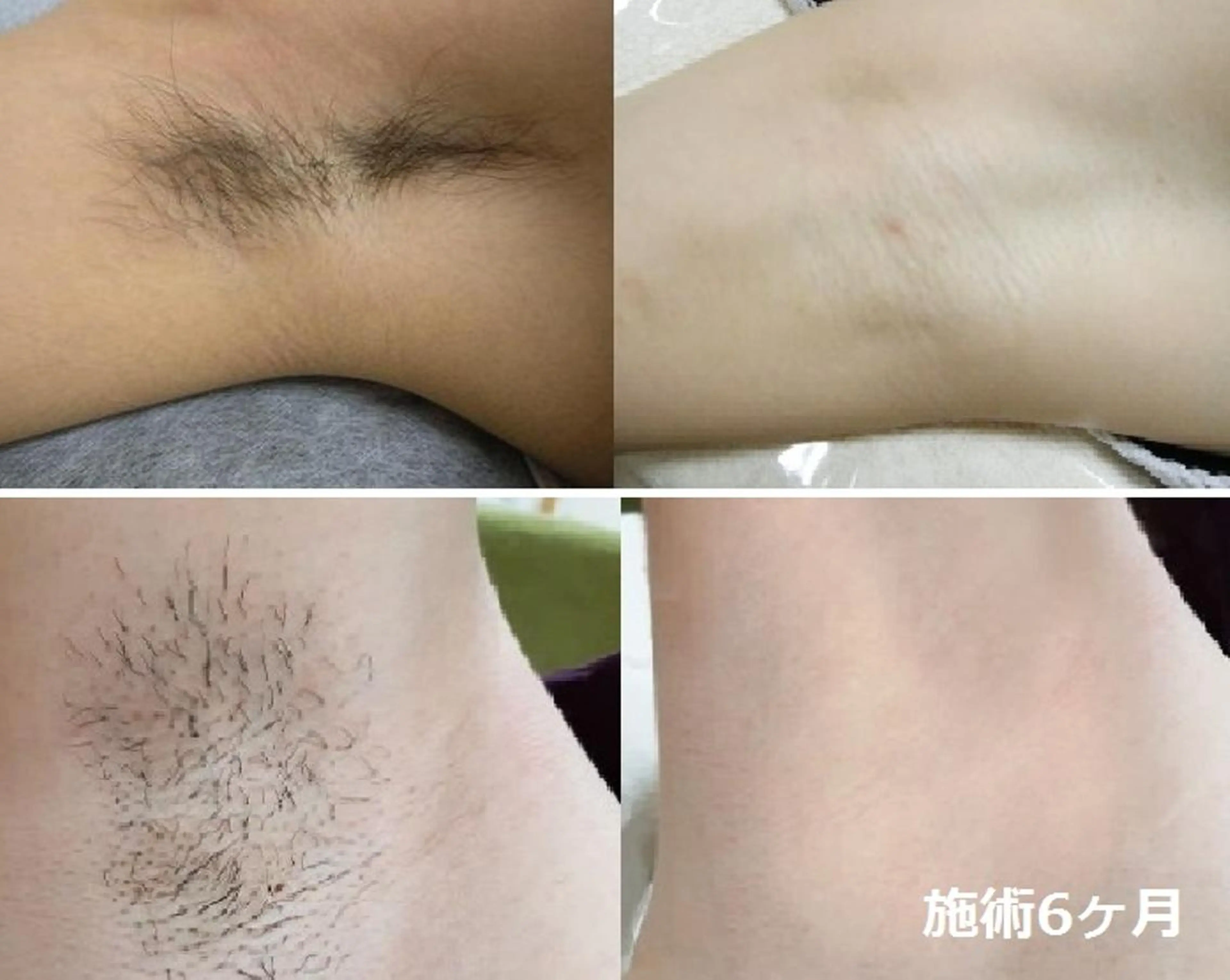 脱毛 顔脱毛＆毛穴＆ニキビ 優良№1♪ヒロコ♪のエステ・リラクイメージ