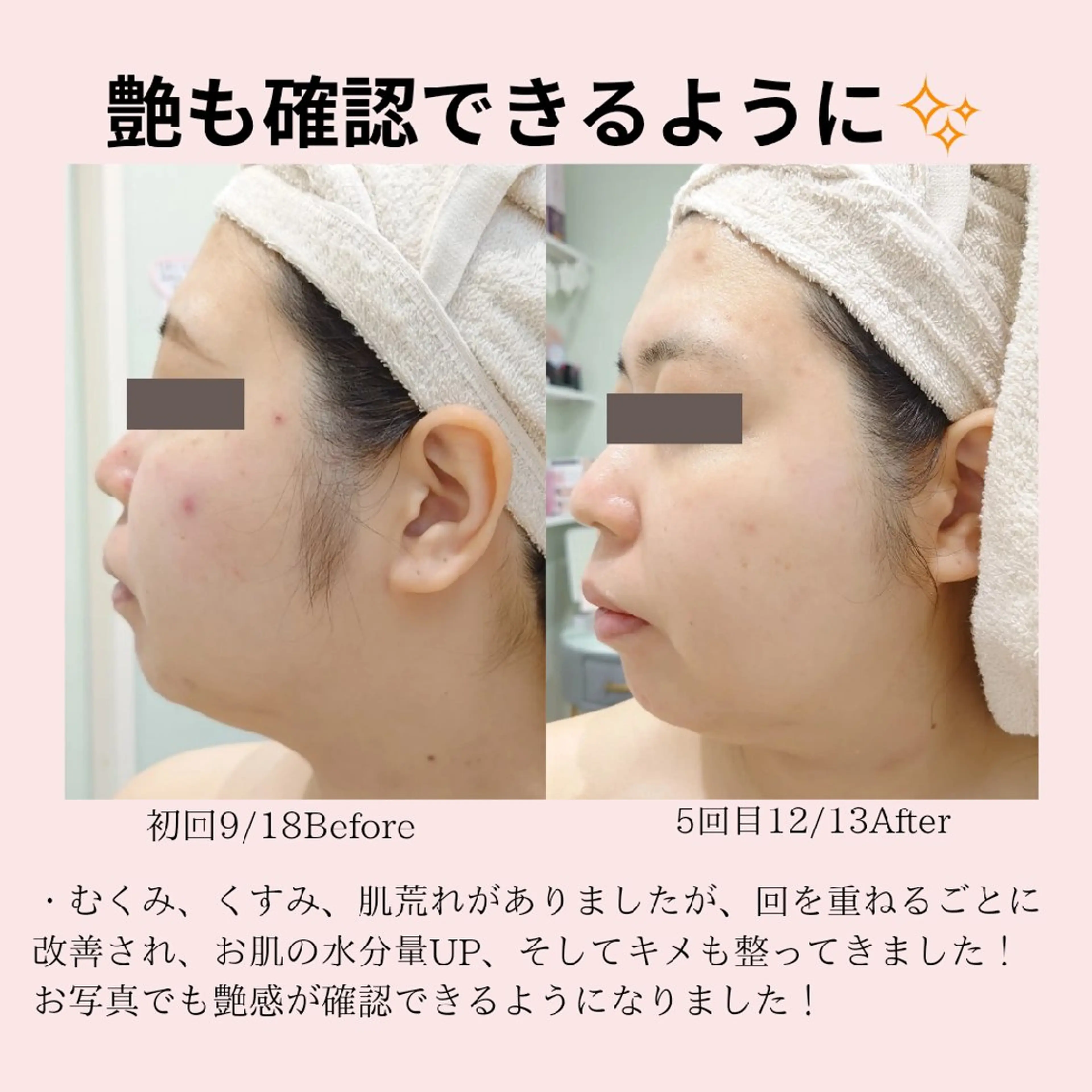 エステ PRETTIEST SHINE所属・山田 浩子のエステ・リラクイメージ