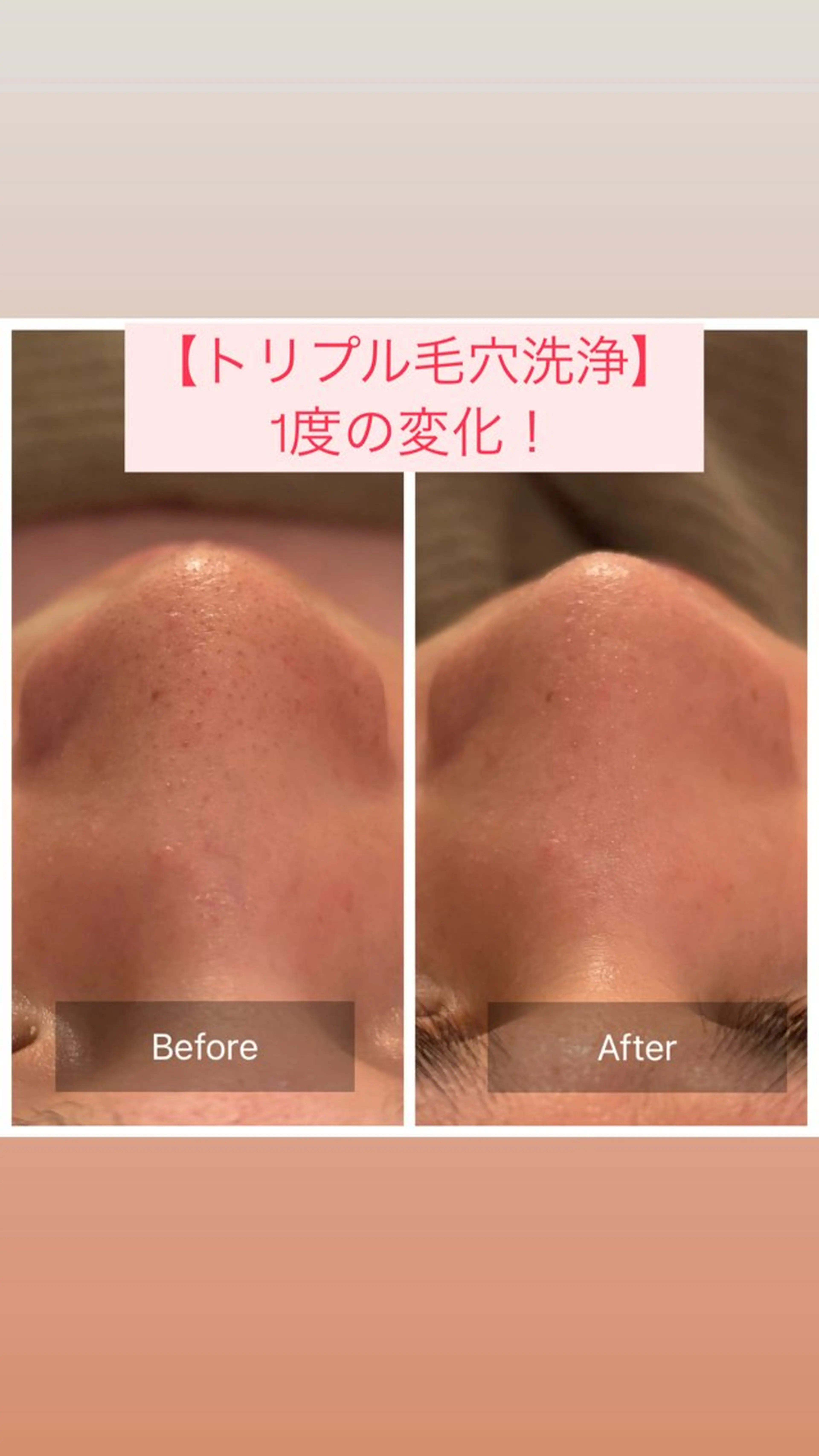 【ミニモ限定】3STEP毛穴洗浄×小顔リンパマッサージ×肌質別パック(プチヘッドスパ＆イオン導入付き)50分の写真